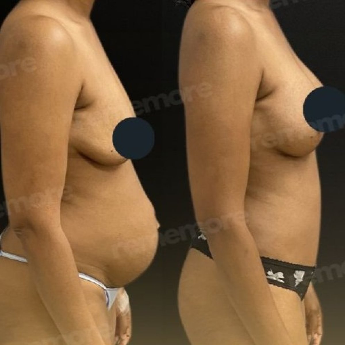 Before and after breast lift results at Memorial Bahçelievler Hospital, improved breast contour