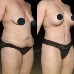 360 liposuction+tummy tuck - photo 4