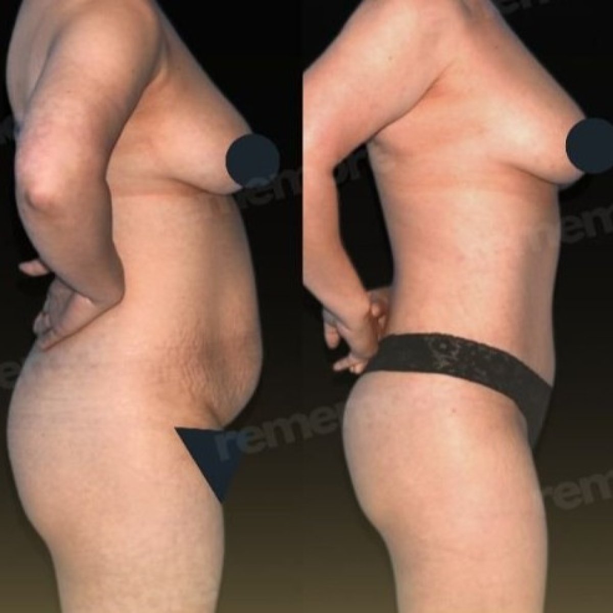 Before and after tummy tuck and liposuction results at Memorial Göztepe Hospital