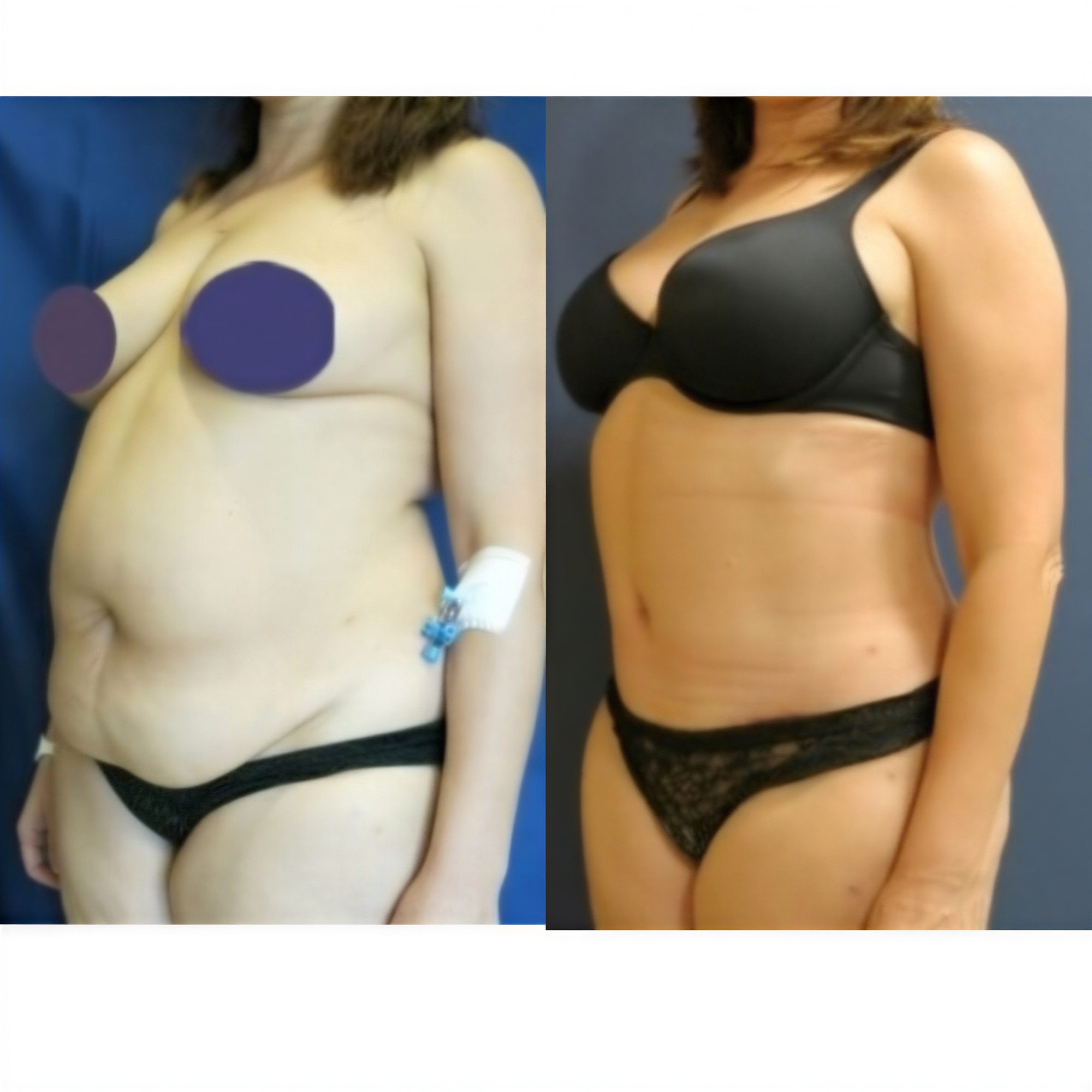 Resultados antes y después de mommy makeover en Memorial Göztepe Hospital, mejor contorno corporal