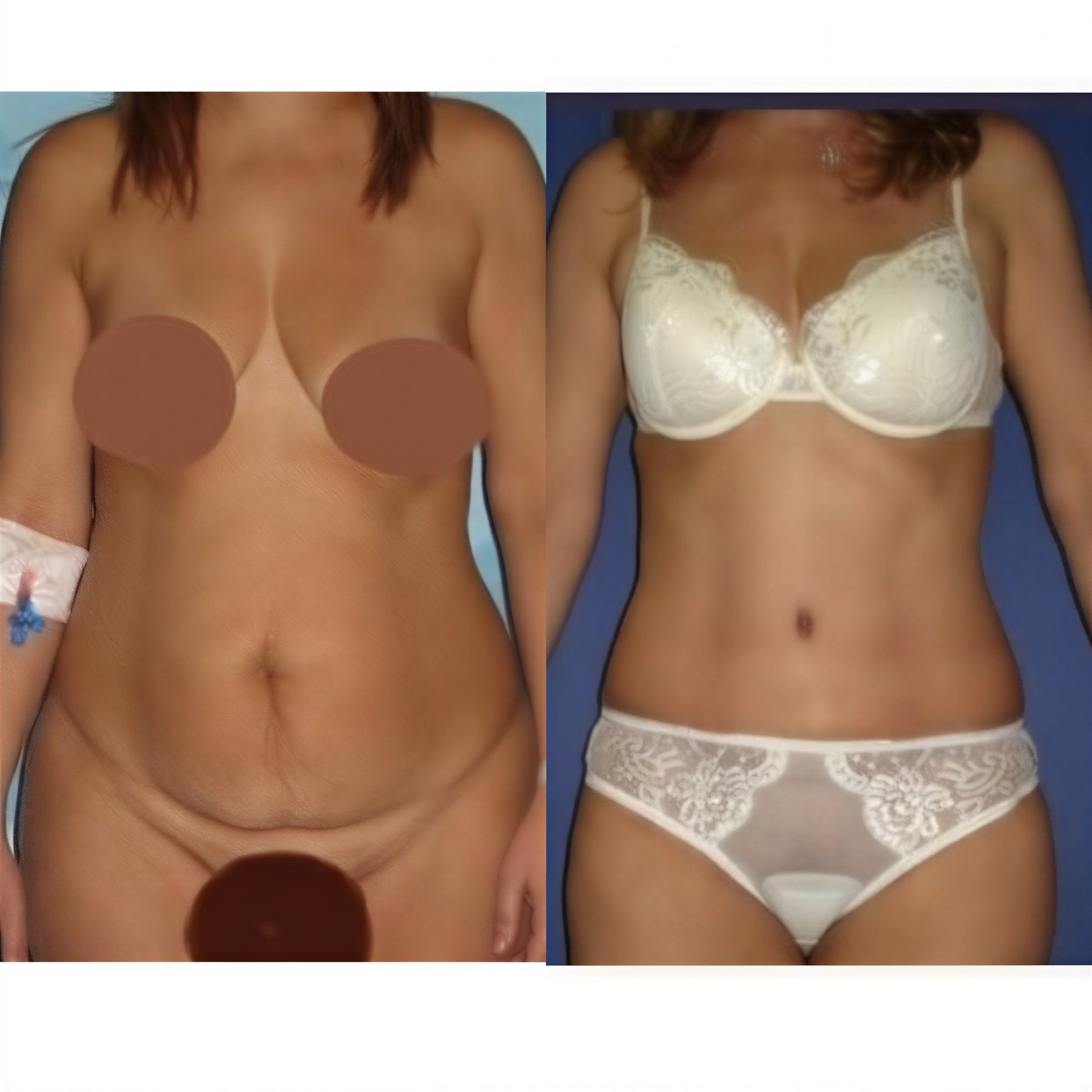 Resultados antes y después de mommy makeover en Memorial Göztepe Hospital, mejor contorno corporal