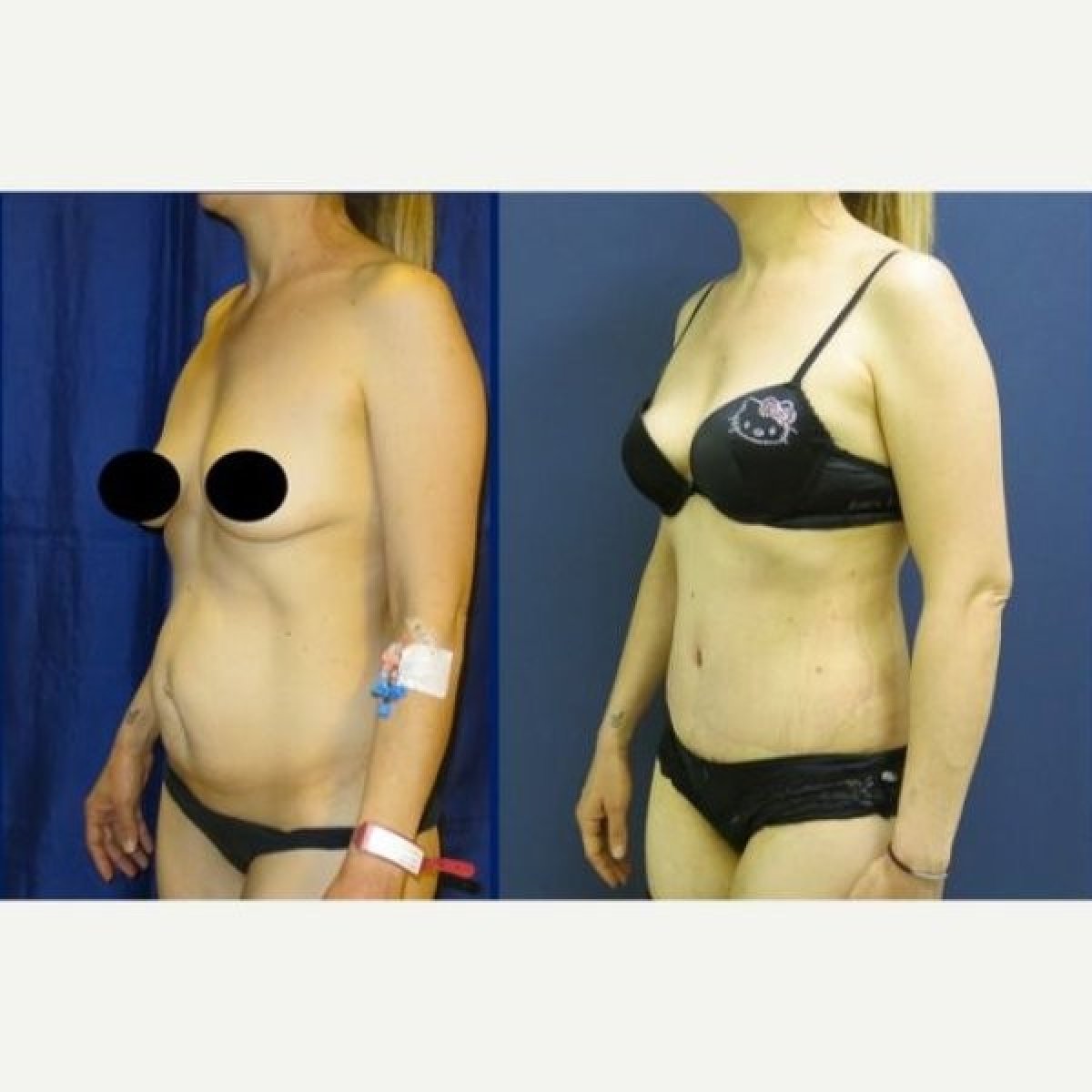 Resultados antes y después de mommy makeover en Memorial Göztepe Hospital, mejora corporal
