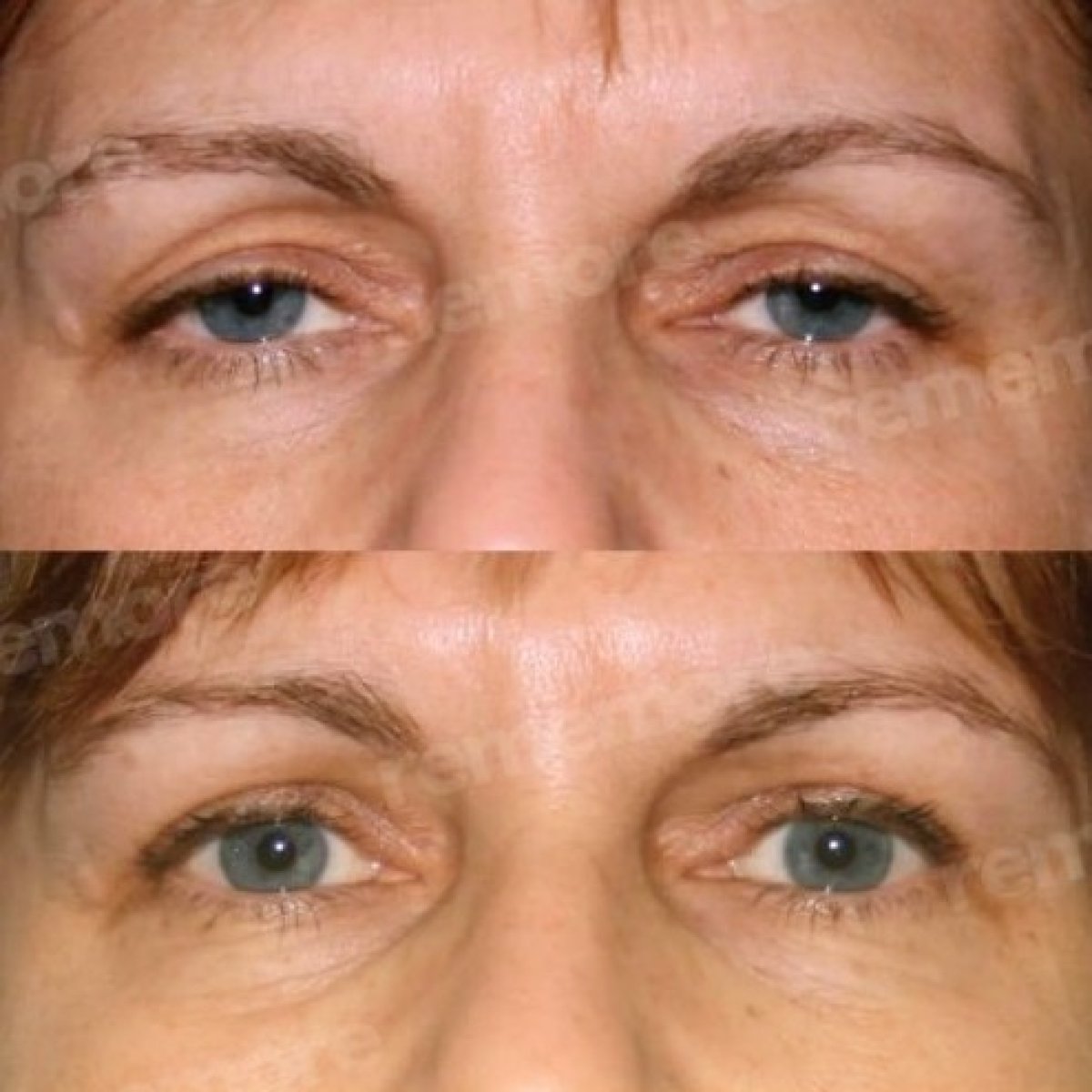 Before and after lower eyelid blepharoplasty results at Memorial Antalya Hospital