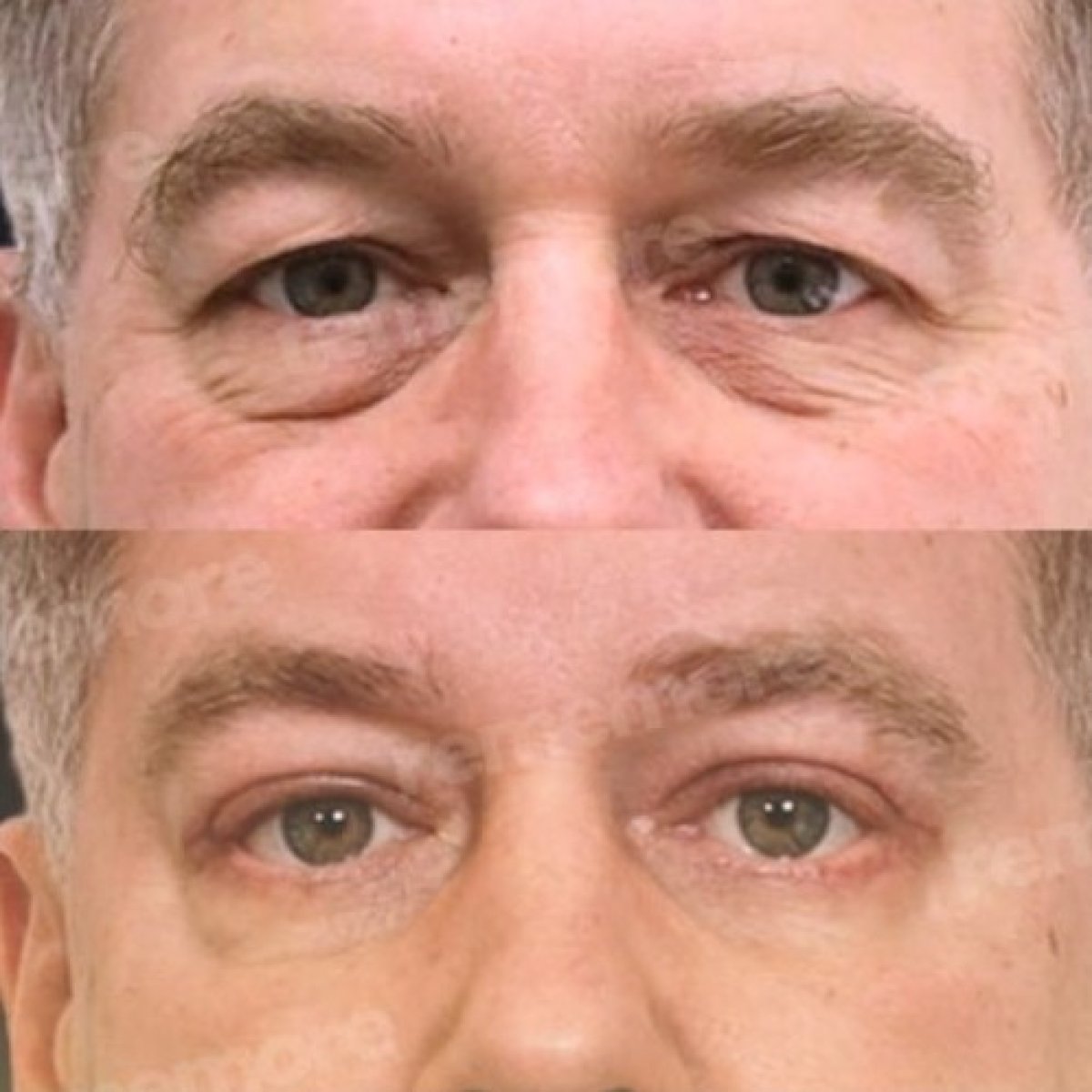 Before and after lower eyelid blepharoplasty results at Memorial Antalya Hospital