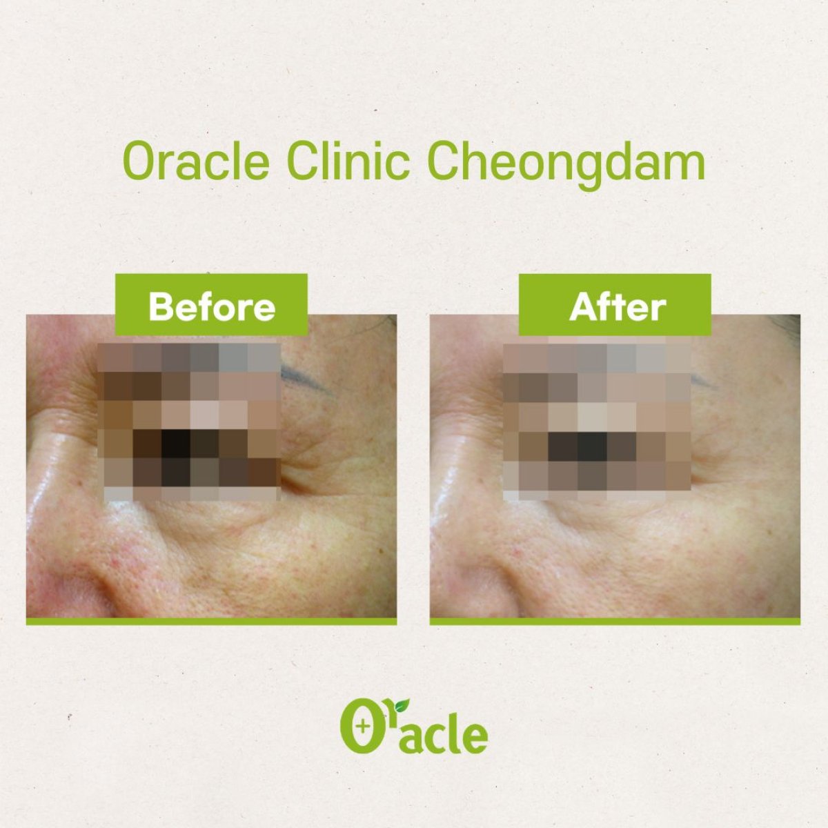 نتائج قبل وبعد تقشير البشرة بالليزر في Oracle Clinic Cheongdam، تحسين ملمس الجلد