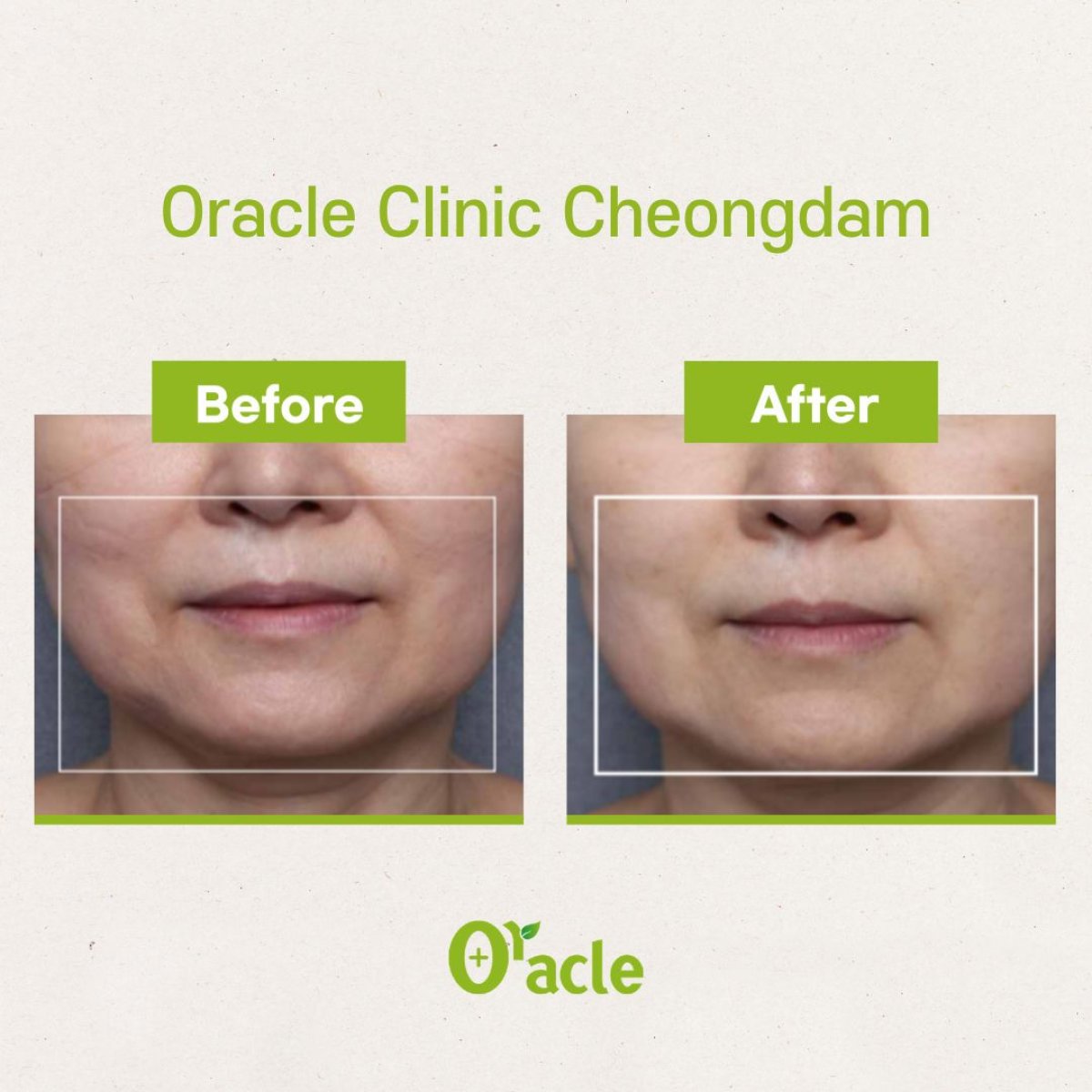 Before and after laser skin resurfacing results at Oracle Clinic Cheongdam, facial rejuvenation