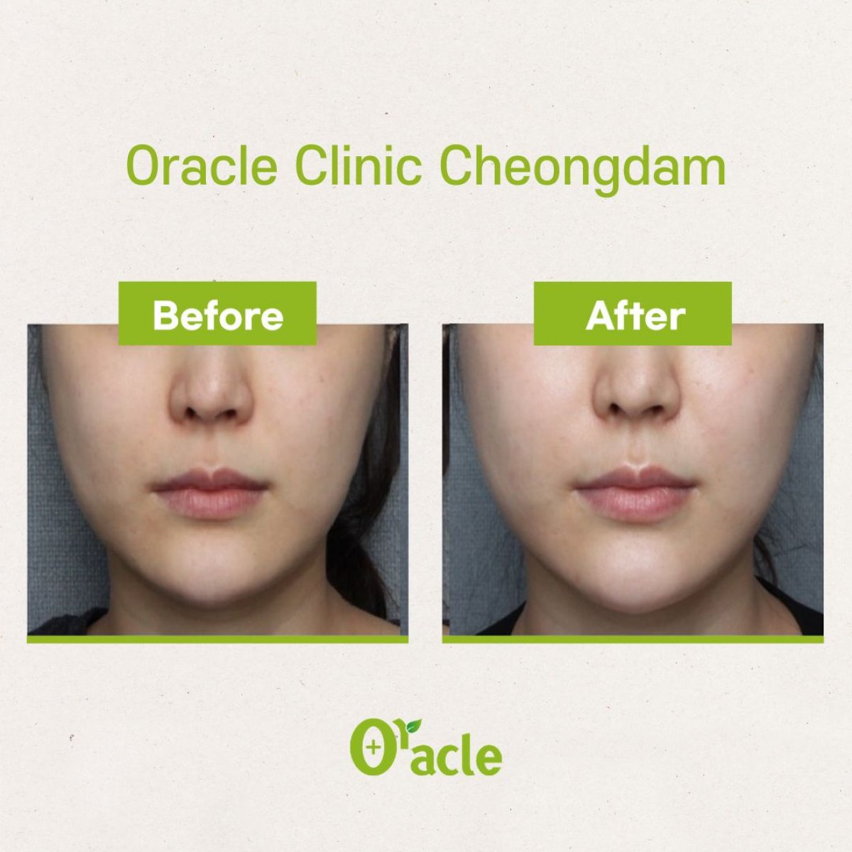 Before and after laser skin resurfacing results at Oracle Clinic Cheongdam, facial rejuvenation