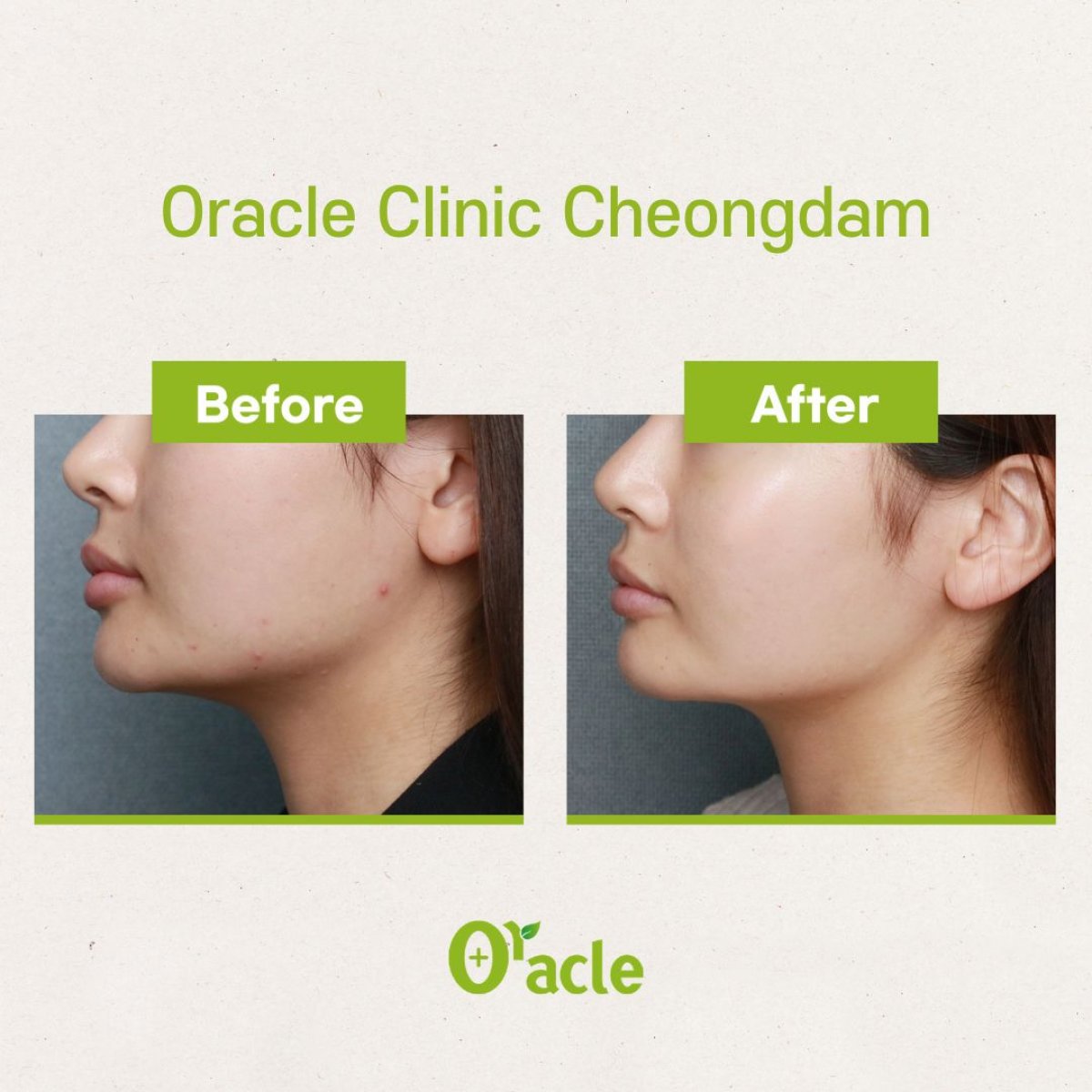 Before and after laser skin resurfacing at Oracle Clinic Cheongdam, improved facial skin texture