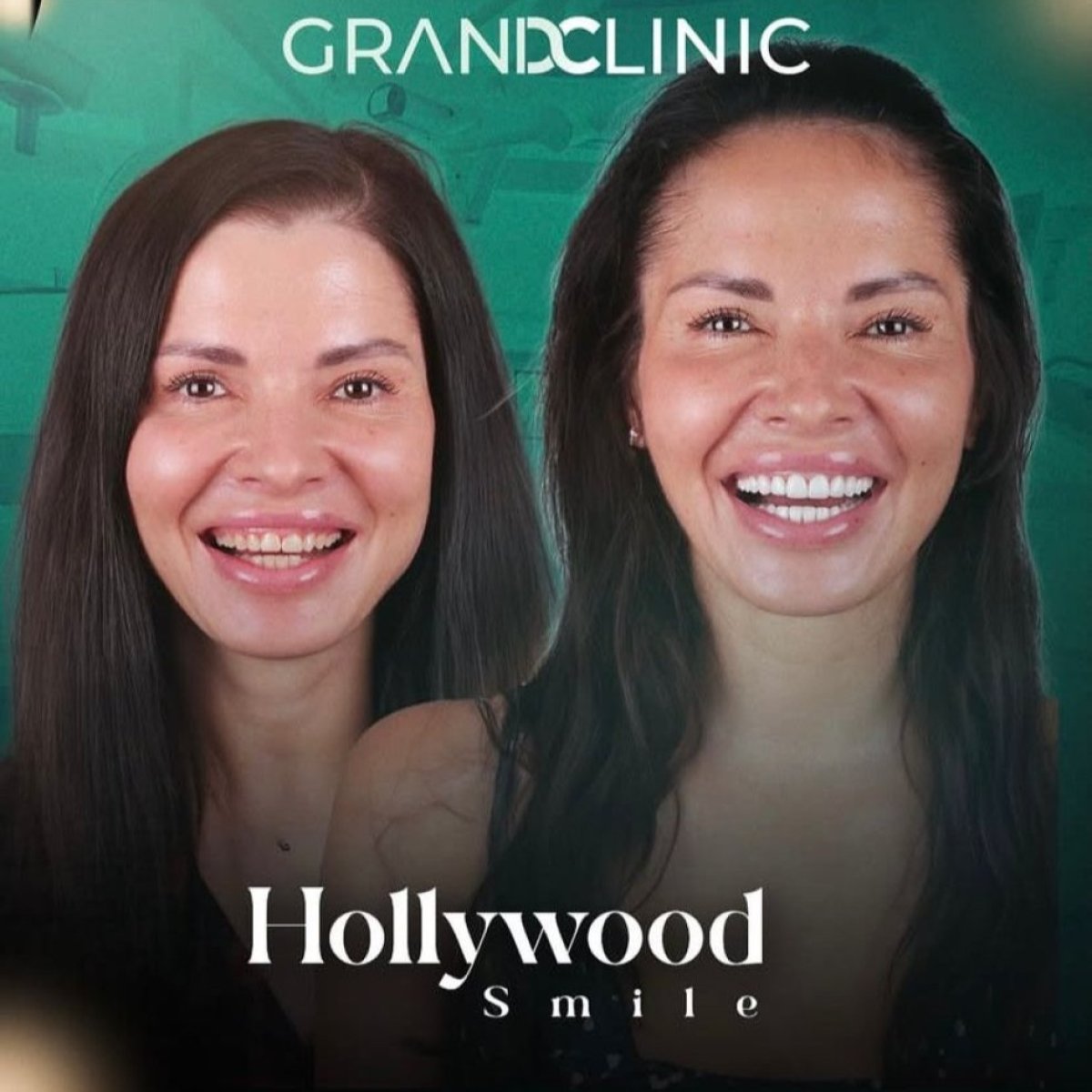 Resultados de Hollywood Smile antes y después en Grand Clinic – transformación visible