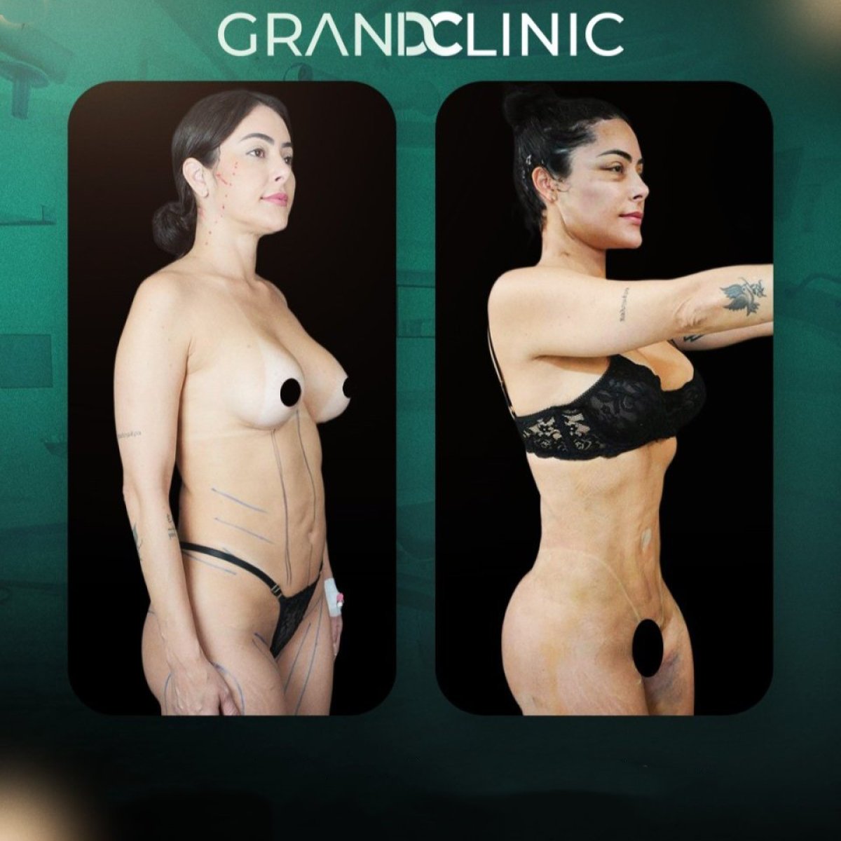قبل وبعد نحت الجسم في Grand Clinic، نتيجة واضحة لنحت الخصر والبطن