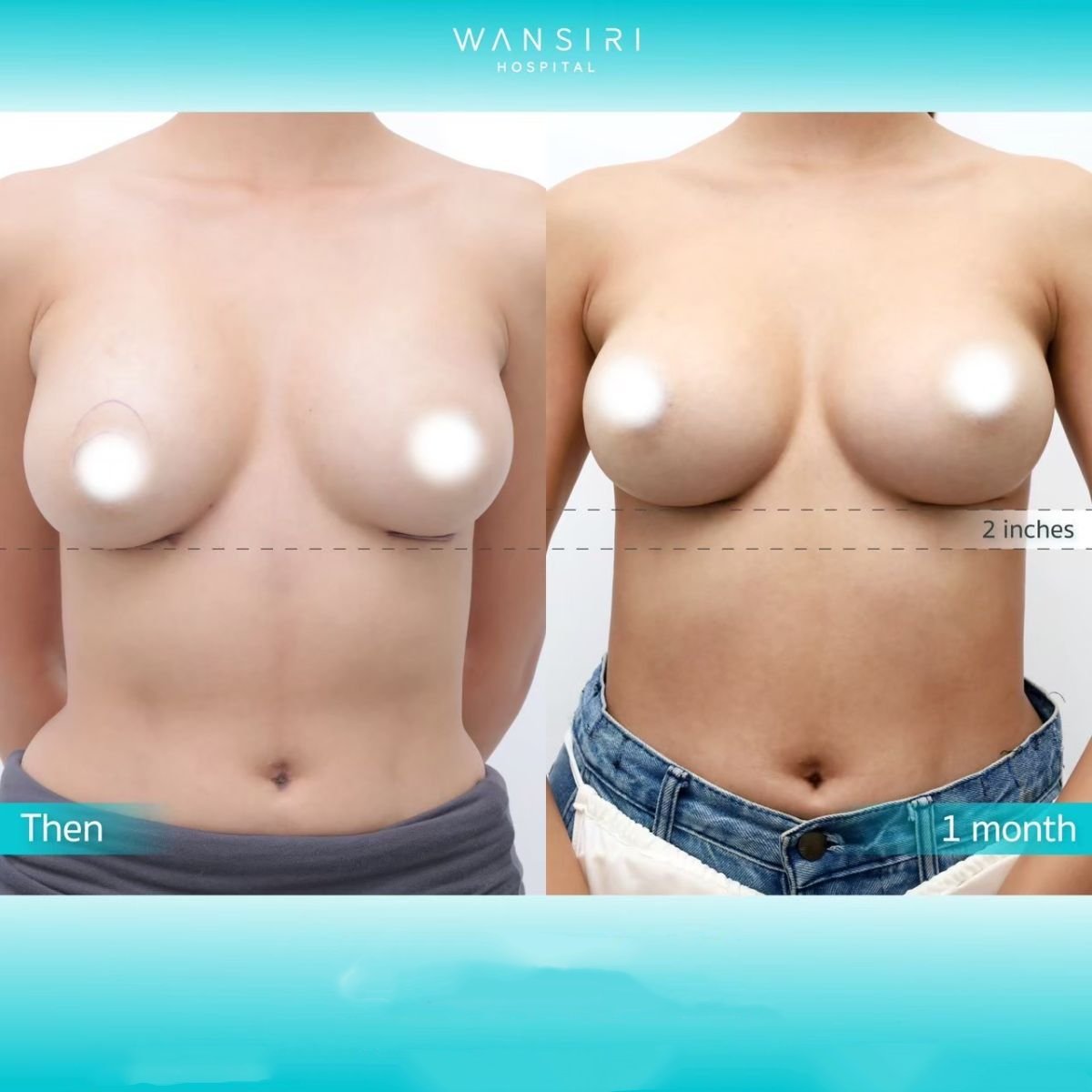 Before and after breast lift results at Wansiri Hospital, visible lift and improved symmetry
