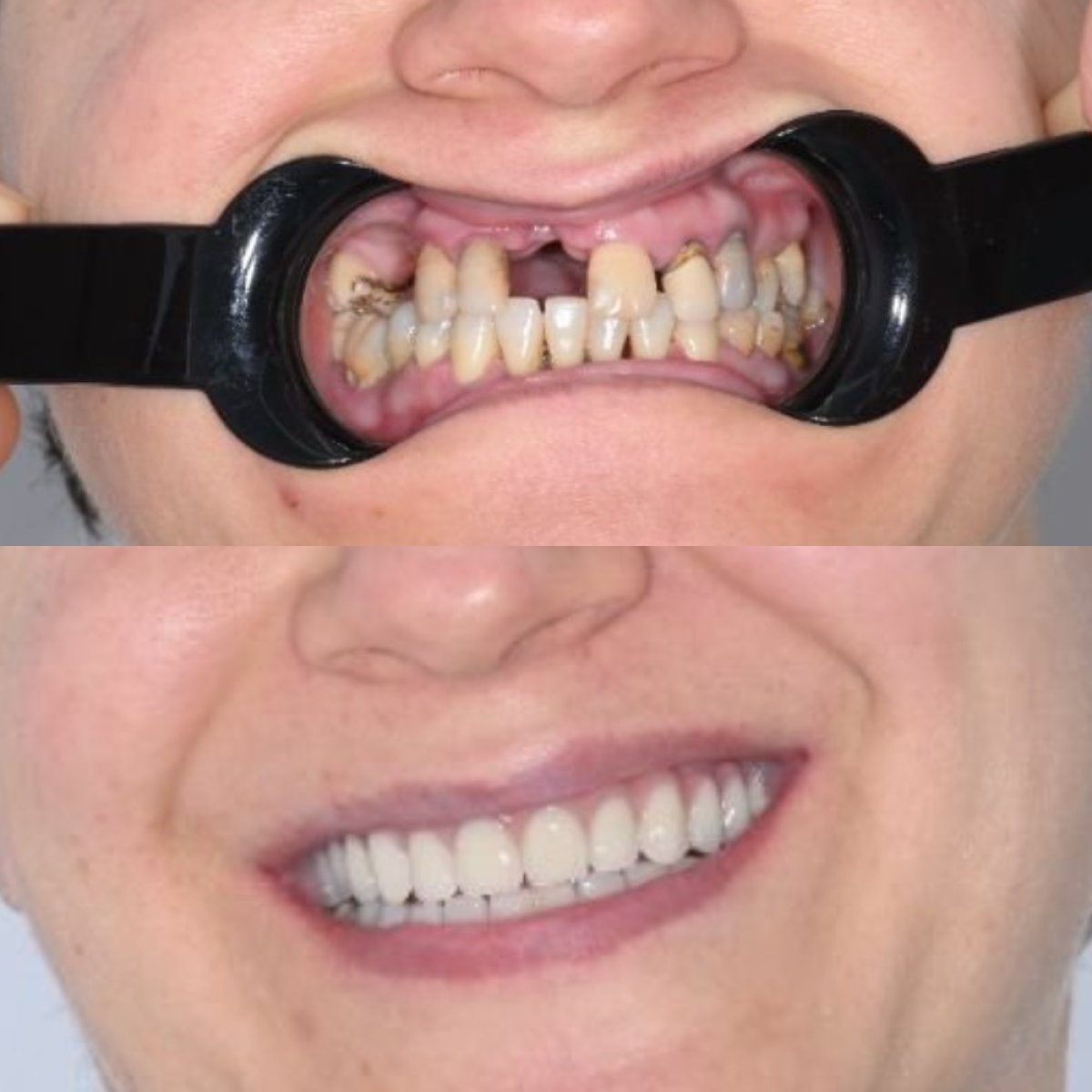 Before and after dental implant results at Unident Clinic – restored smile and healthy teeth
