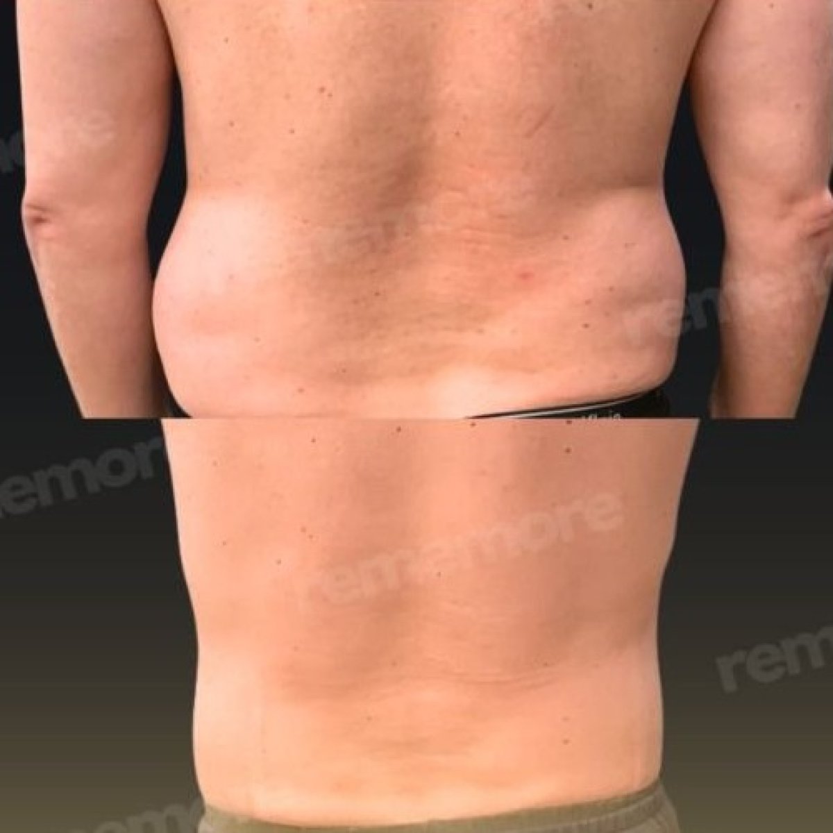 Résultats avant/après liposuccion abdominale à Memorial Bahçelievler Hospital, remodelage corporel