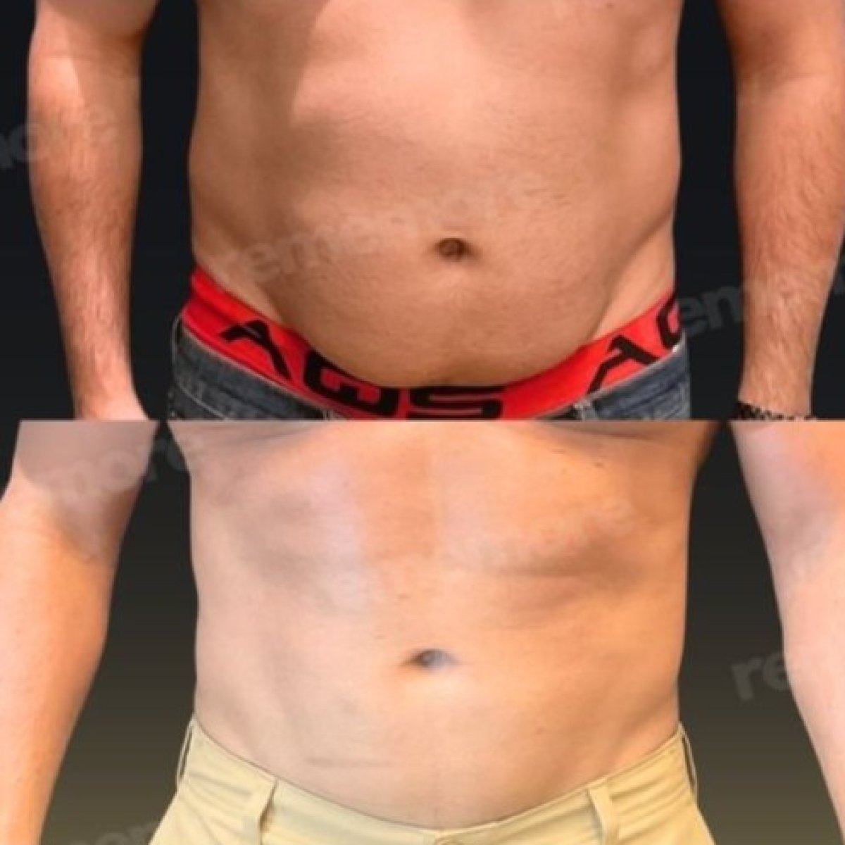 Before and after abdominal liposuction results at Memorial Bahçelievler Hospital, flatter stomach