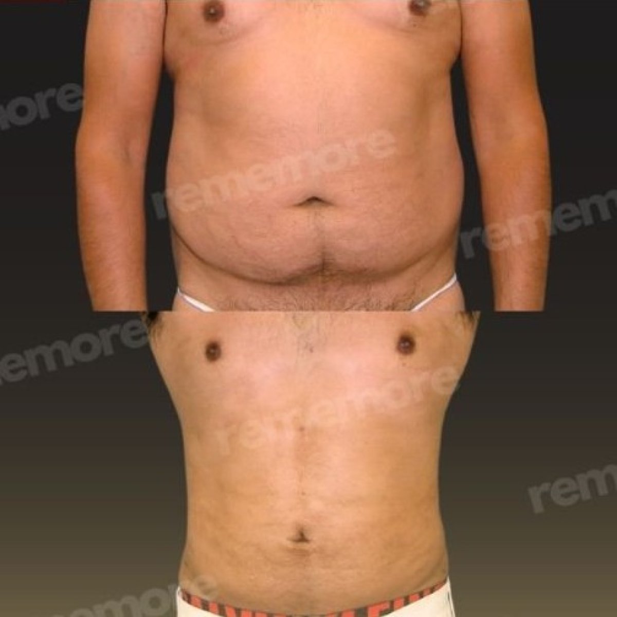 Before and after tummy tuck results at Memorial Göztepe Hospital, improved abdominal contour