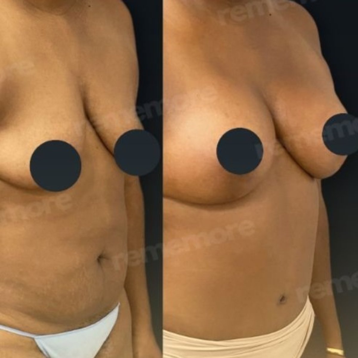 Результаты до и после mommy makeover в Memorial Göztepe Hospital, улучшение контуров тела