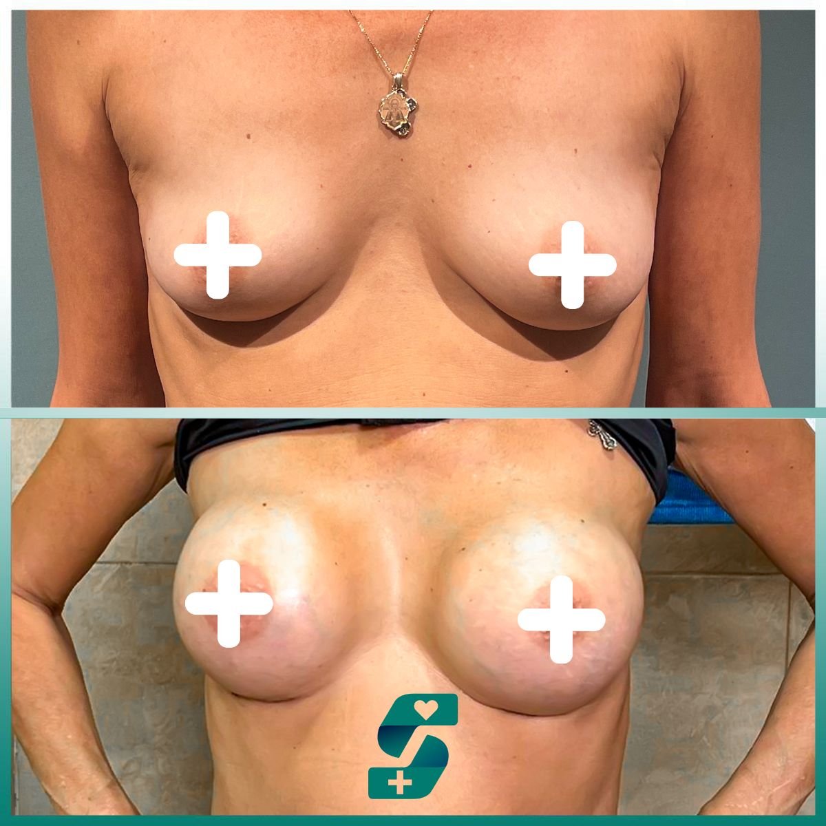 Antes y después de mastopexia con implantes redondos en Soraca Med Istanbul, resultado mejorado