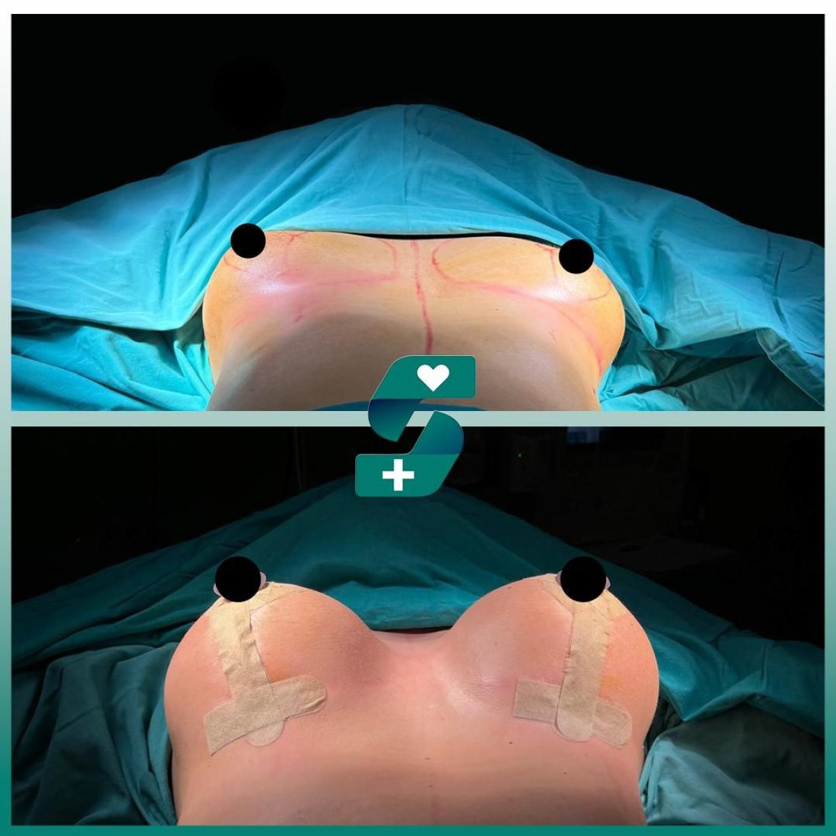 Antes y después de mastopexia con implantes redondos en Soraca Med Istanbul, resultado mejorado
