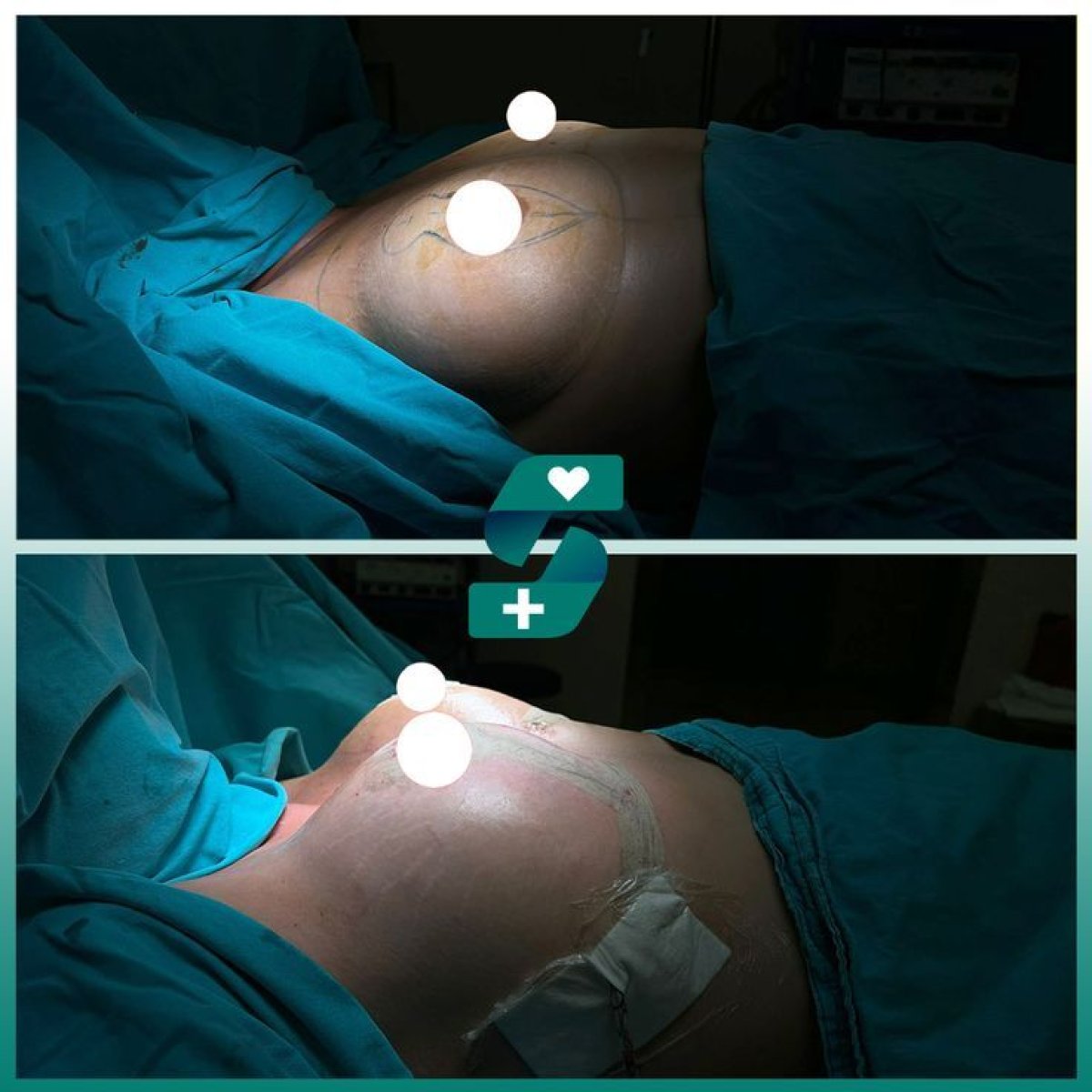Antes y después de mastopexia con implantes redondos en Soraca Med Istanbul, resultado visible