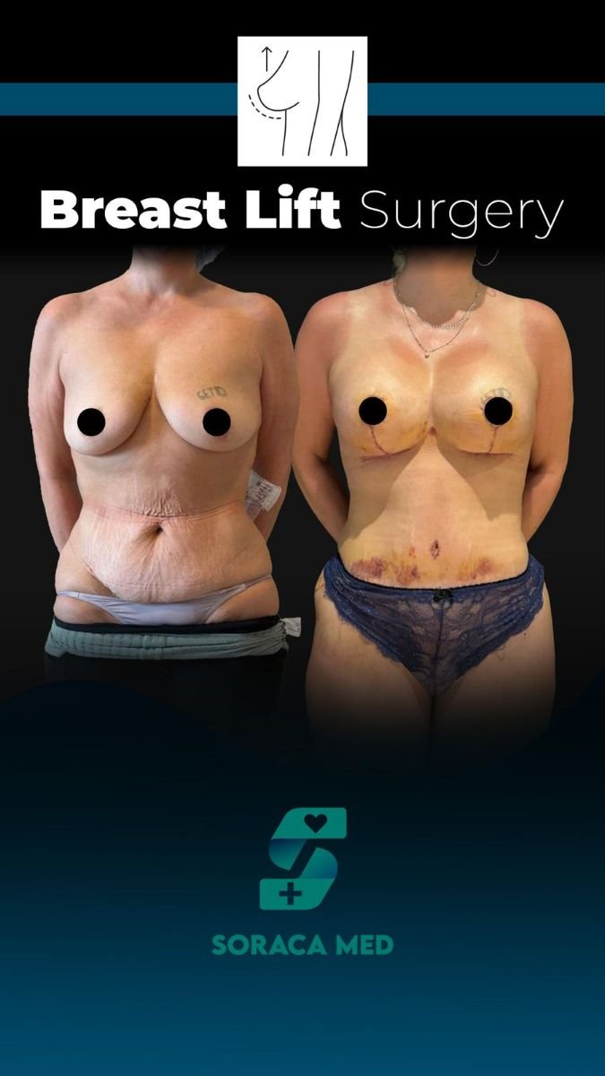 Antes y después de elevación de senos con implantes en Soraca Med Istanbul, resultado visible