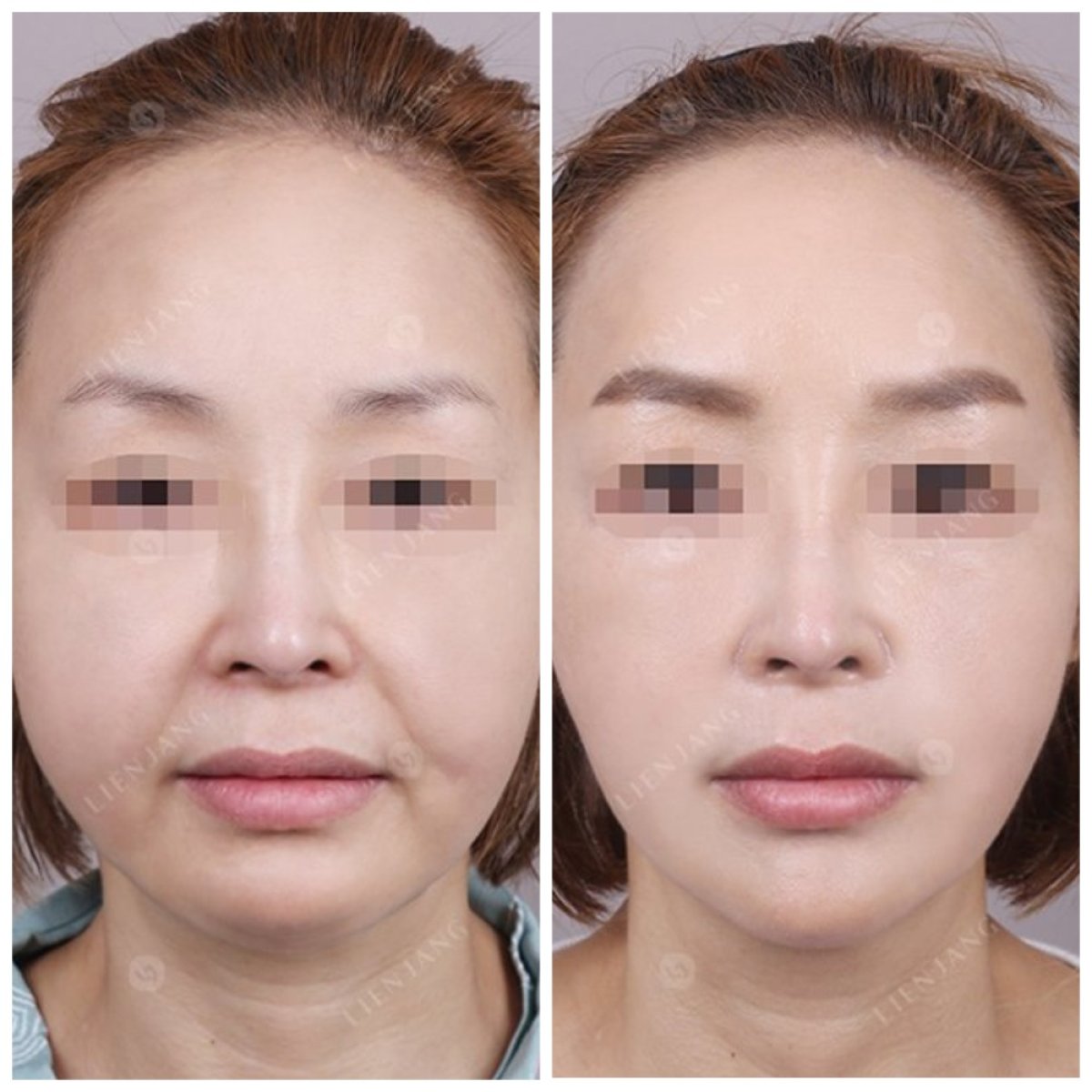 Resultados de lifting facial antes y después en Lienjang Clinic – rejuvenecimiento visible