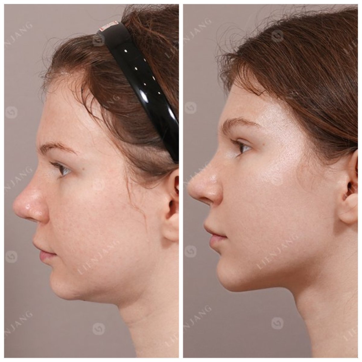 Resultados de lifting de cuello antes y después – contorno mejorado en Lienjang