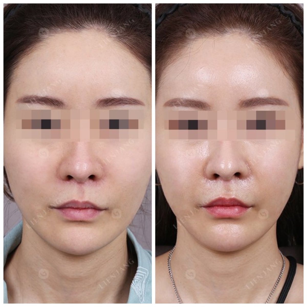 Résultats avant et après réduction des pommettes, amélioration du contour du visage