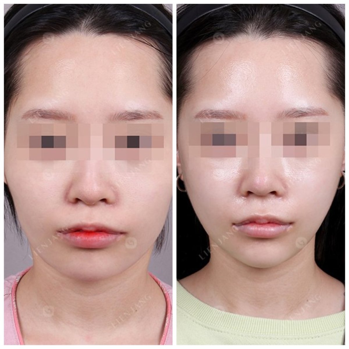 Résultats avant et après réduction des pommettes, amélioration du contour du visage en clinique