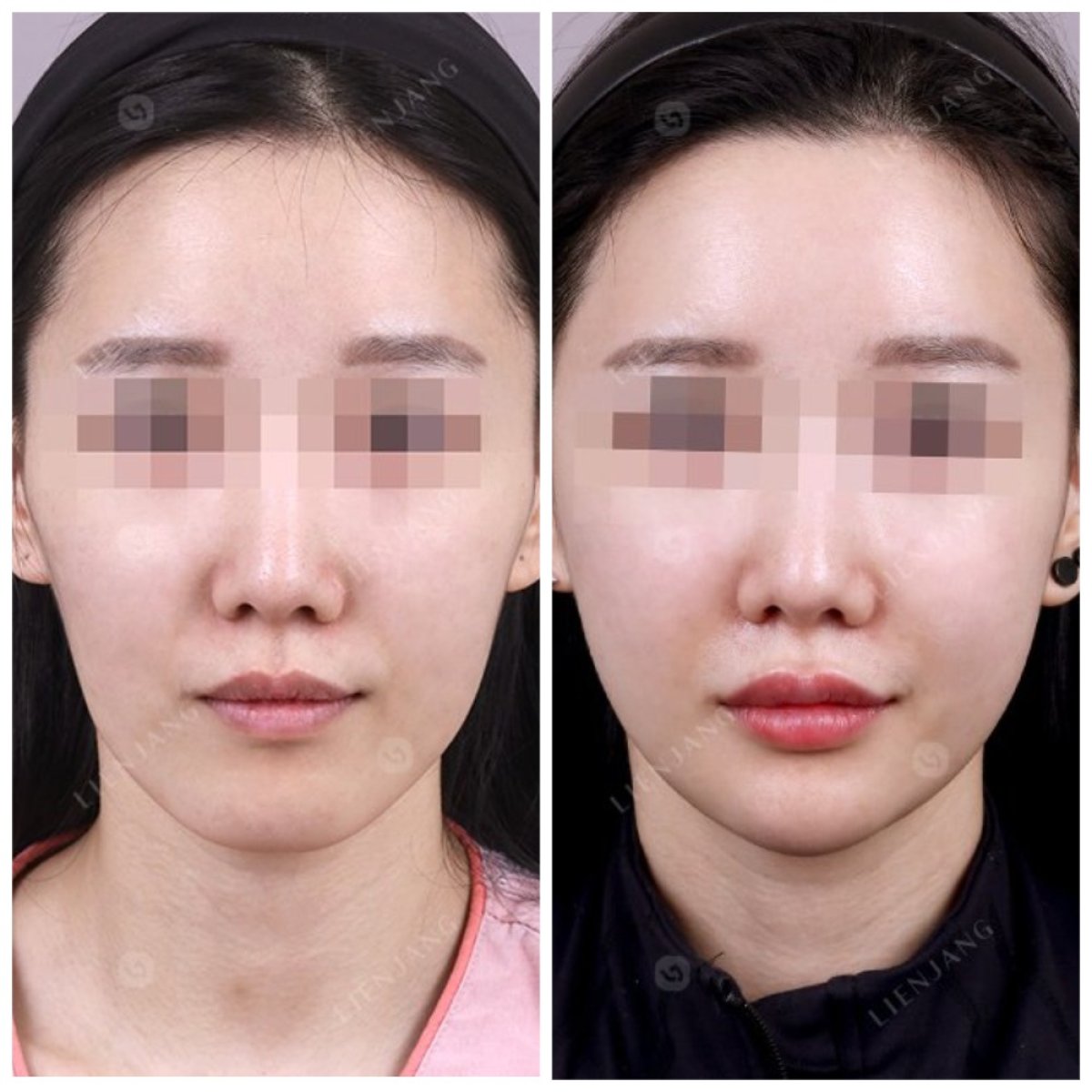 Before and after jaw shaping results at Lienjang Clinic – enhanced facial contour