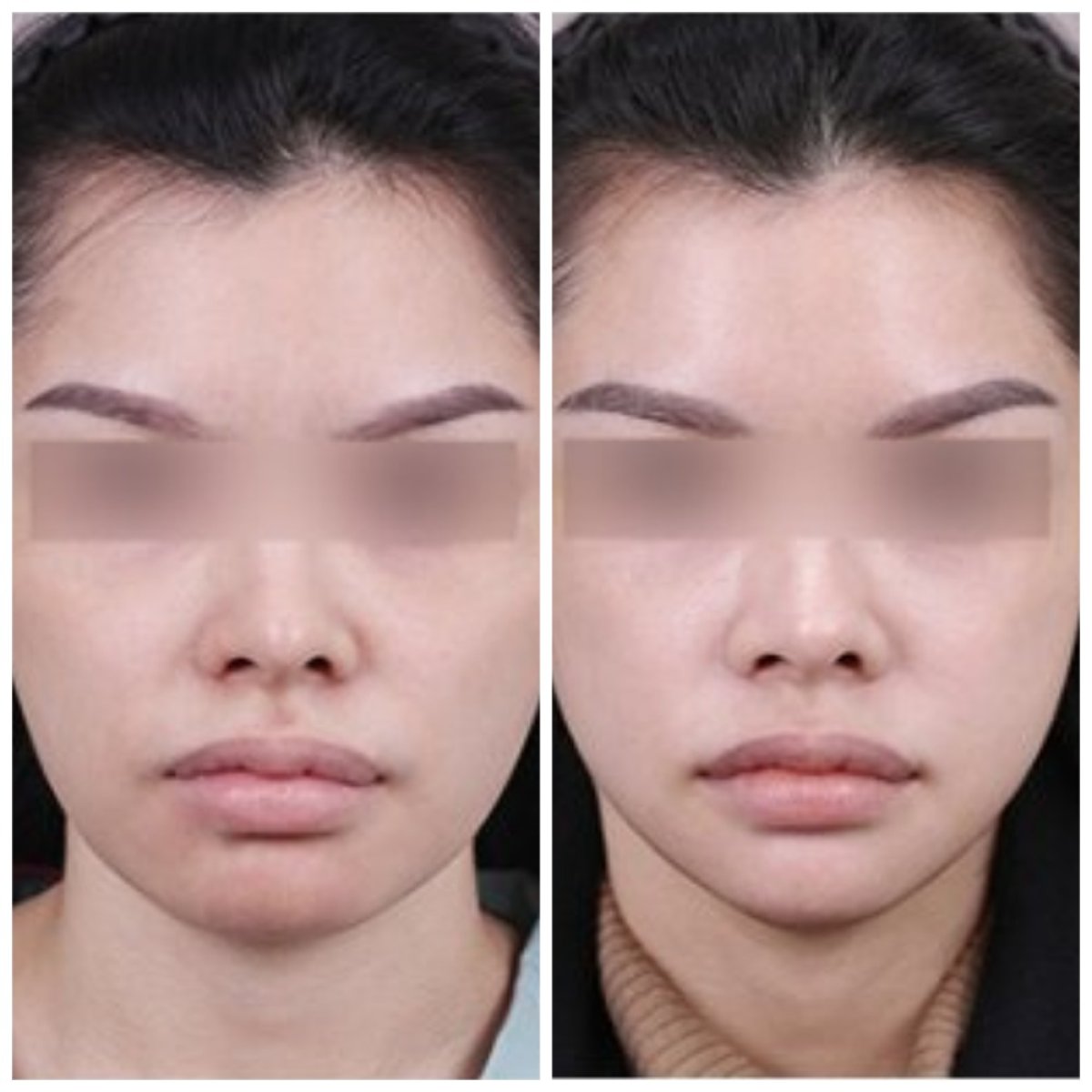 Resultados antes y después de perfilado de mandíbula – contorno facial y línea mandibular mejorados