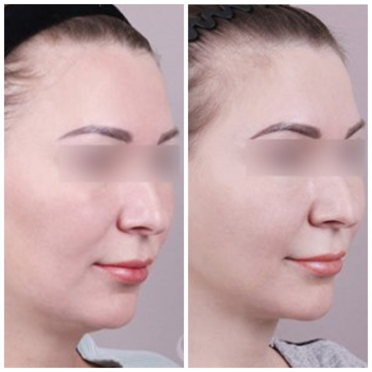 Resultados antes y después de perfilado de mandíbula – contorno facial mejorado
