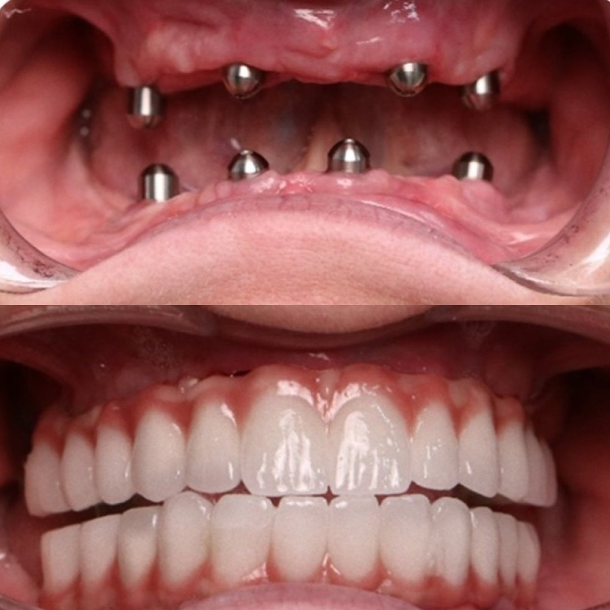 Before and after result of full-arch zirconia implant dentures on 6 titanium implants