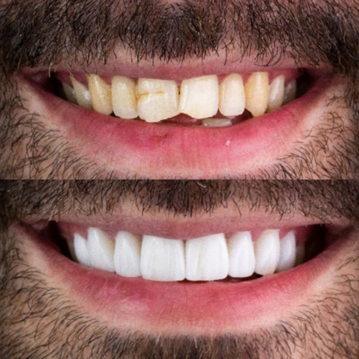 Before and after tooth whitening results – visibly brighter smile after dental procedure