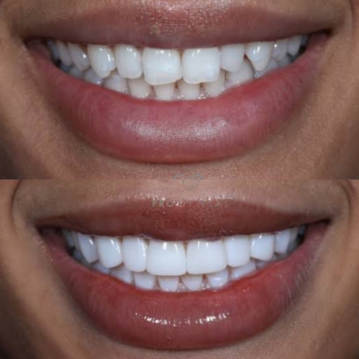 Before and after composite veneer results – improved smile aesthetics and whiter teeth