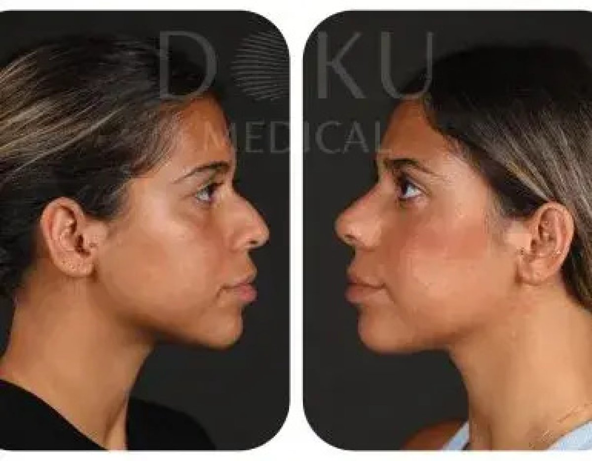 Resultados de rinoplastia antes y después en Doku Medical, perfil nasal natural