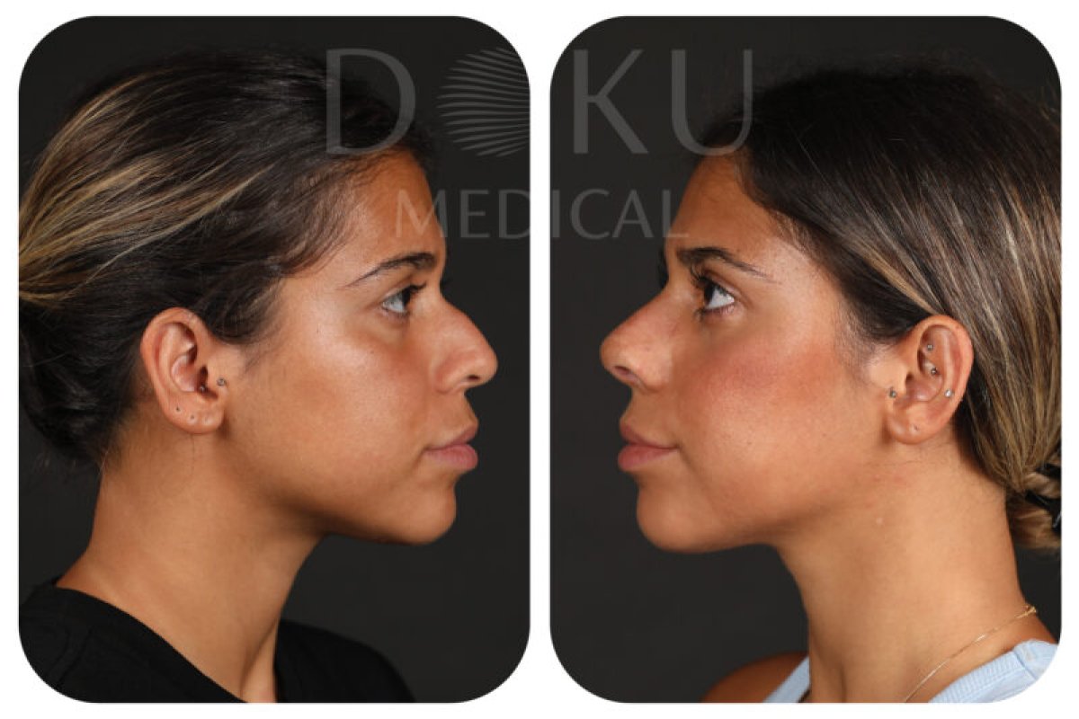 Resultados de rinoplastia antes y después en Doku Medical, perfil nasal natural