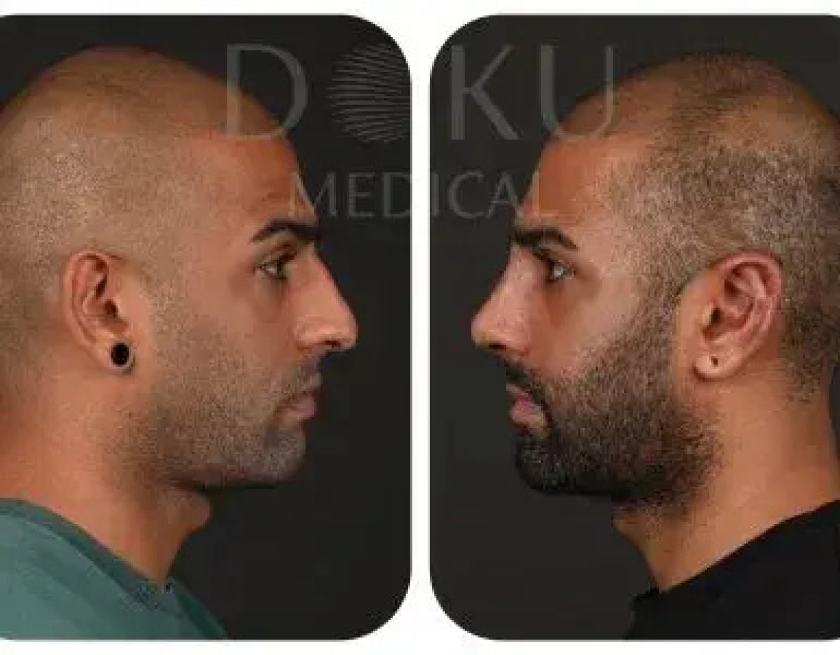 نتائج عملية تجميل الأنف قبل وبعد في Doku Medical، تحسين شكل الأنف لرجل
