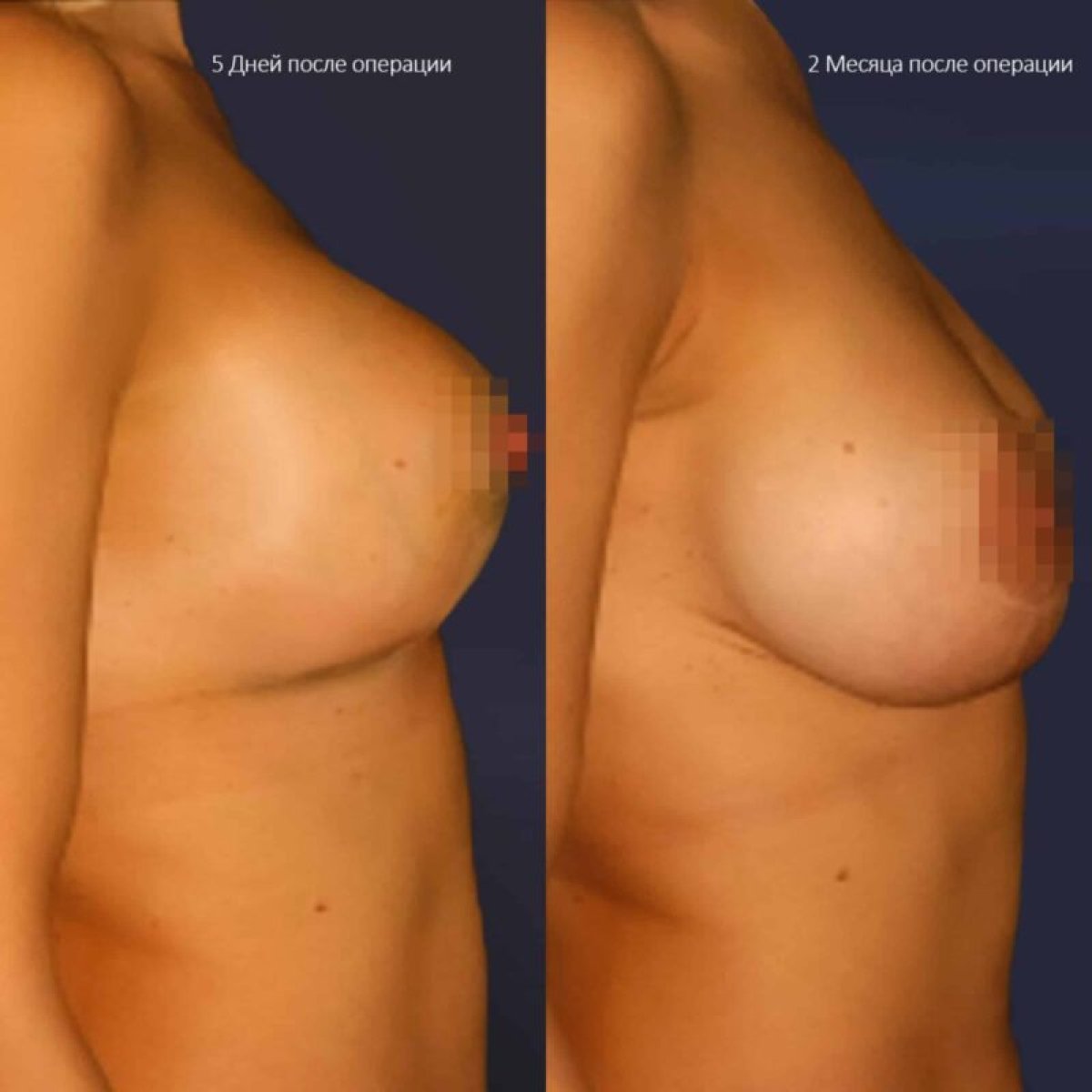 Before and after breast lift results – improved breast shape and contour after surgery