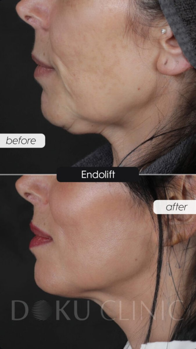 Resultados de lifting de cuello Endolift en Doku Clinic: definición visible de la mandíbula