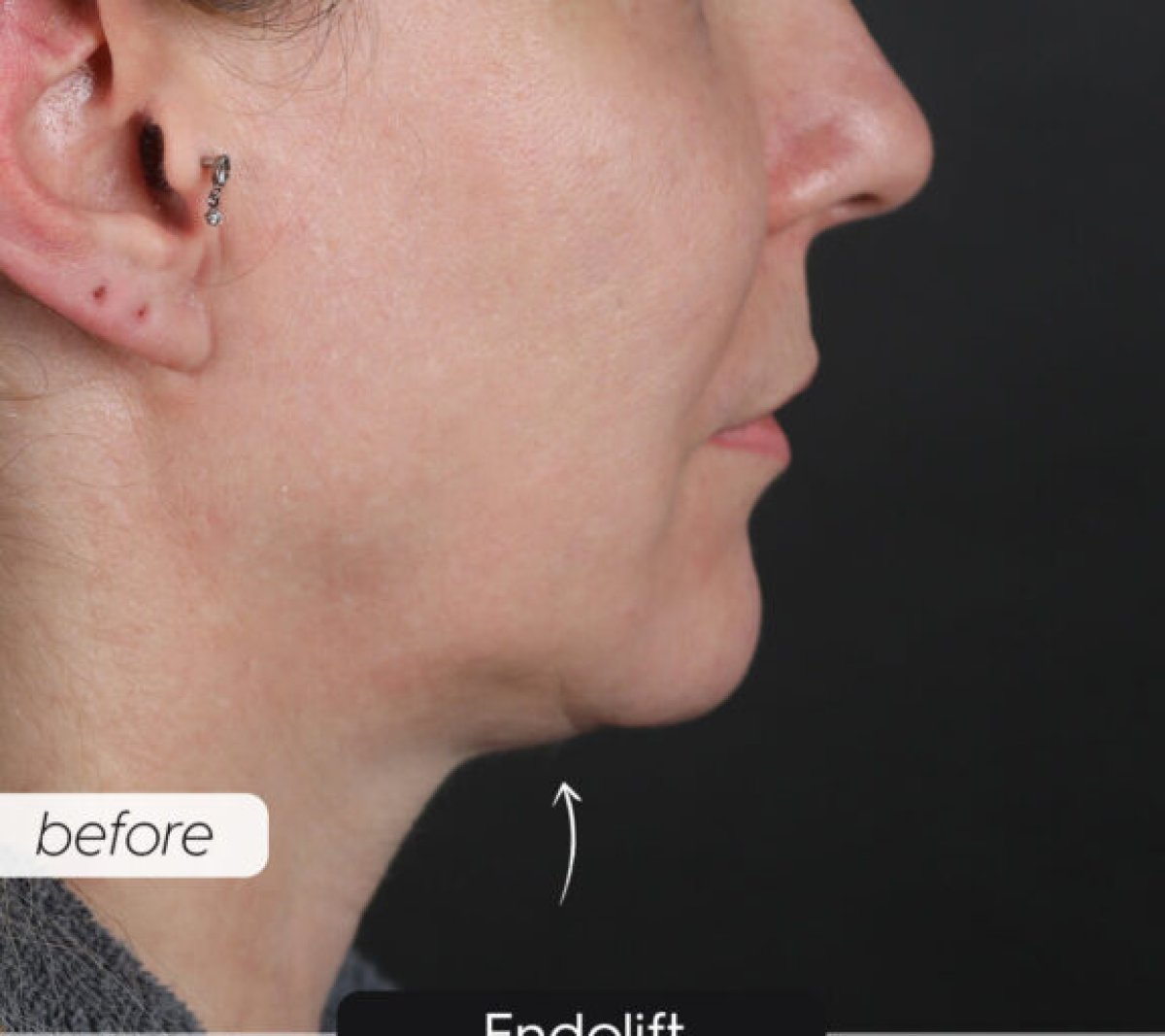 Resultado antes de lifting de cuello, piel flácida visible en mandíbula y cuello