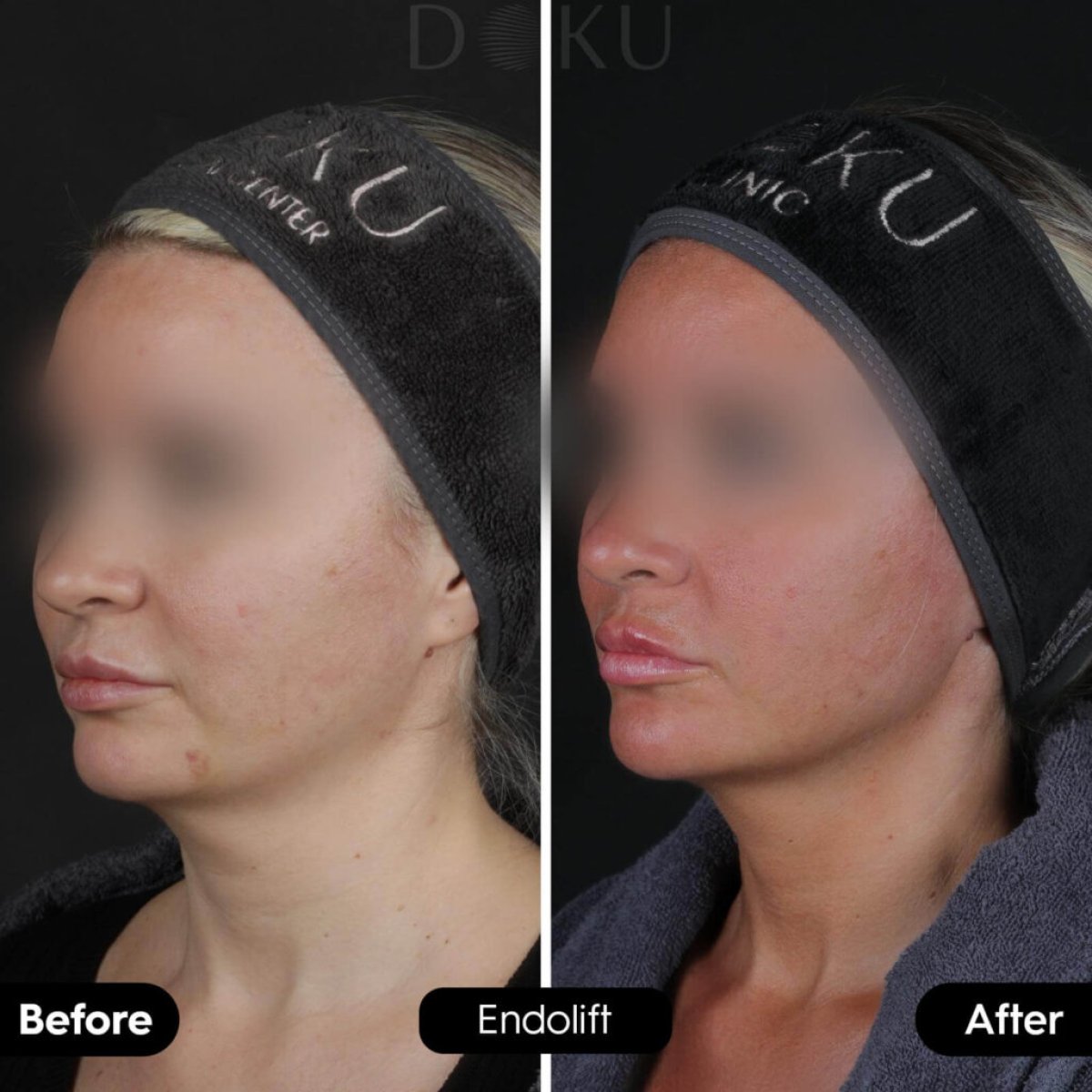 Before and after Endolift neck lift results at Doku Clinic – visible skin tightening effect
