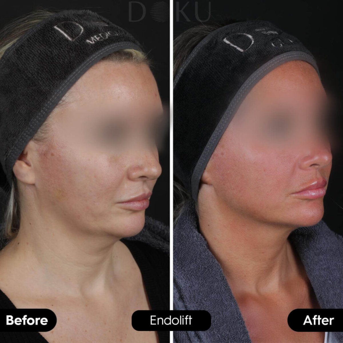 Before and after Endolift neck lift results at Doku Clinic – improved jawline definition