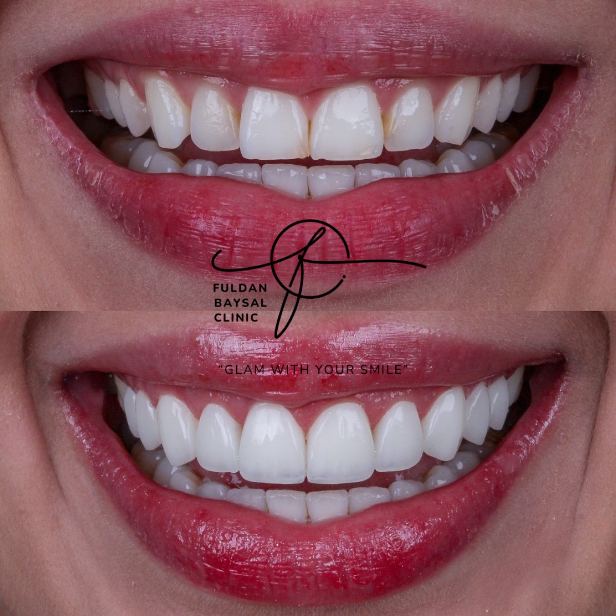 Before and after dental veneers result at Fuldan Baysal Clinic – smile makeover transformation