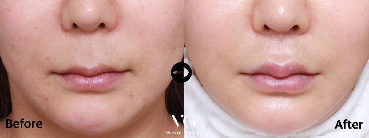 نتائج رفع الشفاه قبل وبعد في VG Plastic Surgery، تحسين شكل وحجم الشفة العليا