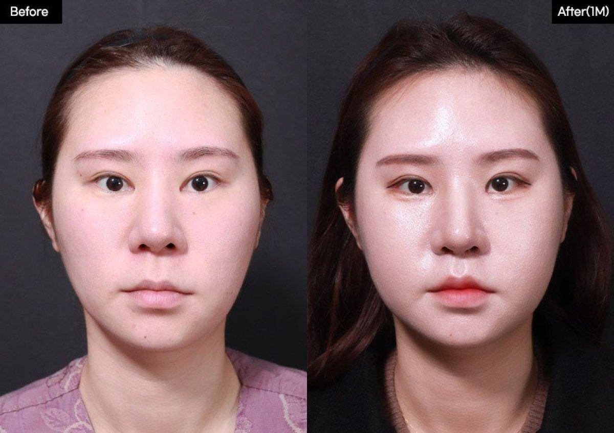 نتائج رفع الشفاه قبل وبعد في VG Plastic Surgery، تحديد وشكل شفاه ممتلئ أكثر