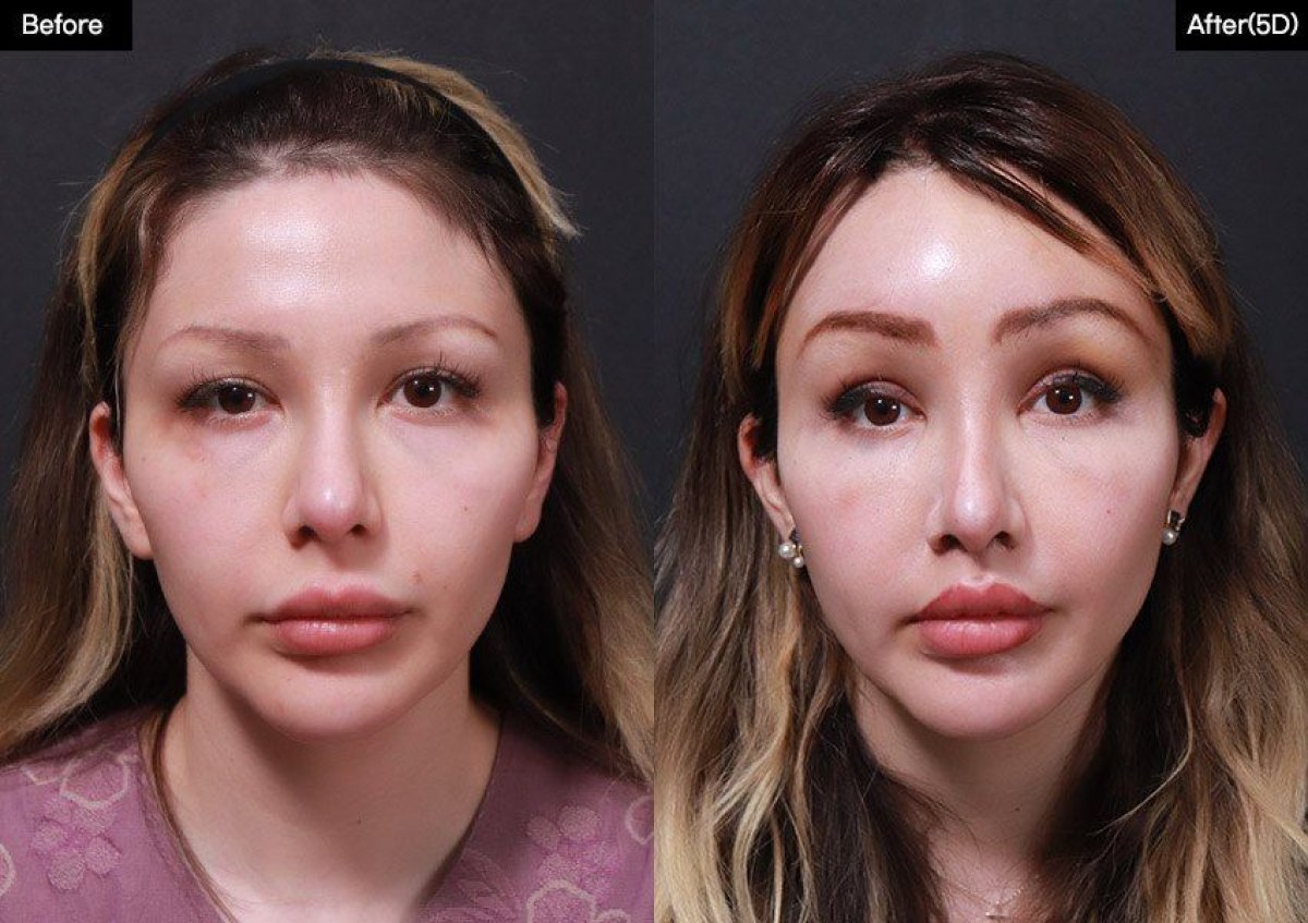 Resultados antes y después de lip lift en VG Plastic Surgery, mayor contorno y volumen labial