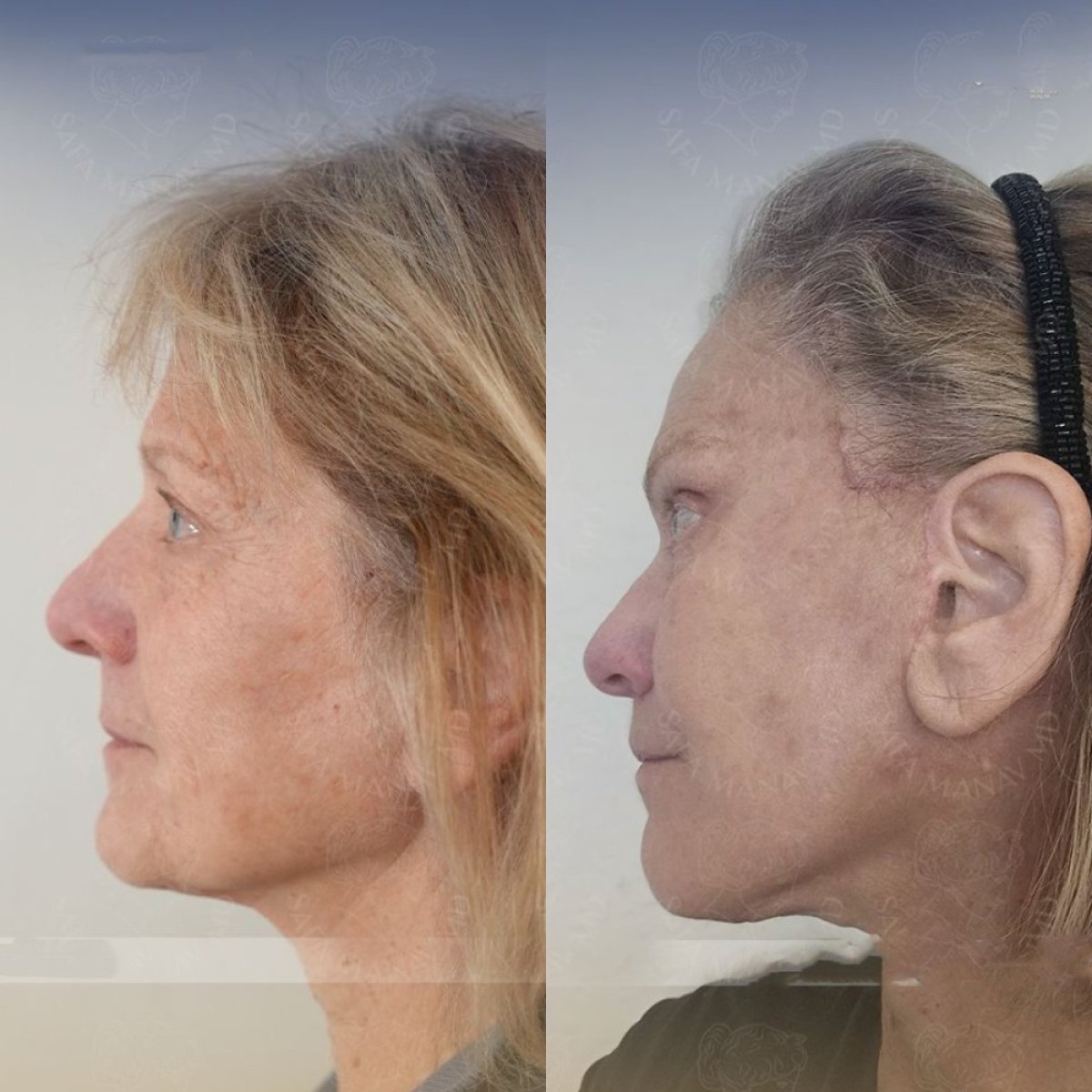 Resultados de lifting facial antes y después en Dr. Safa Manav Clinic, rejuvenecimiento visible