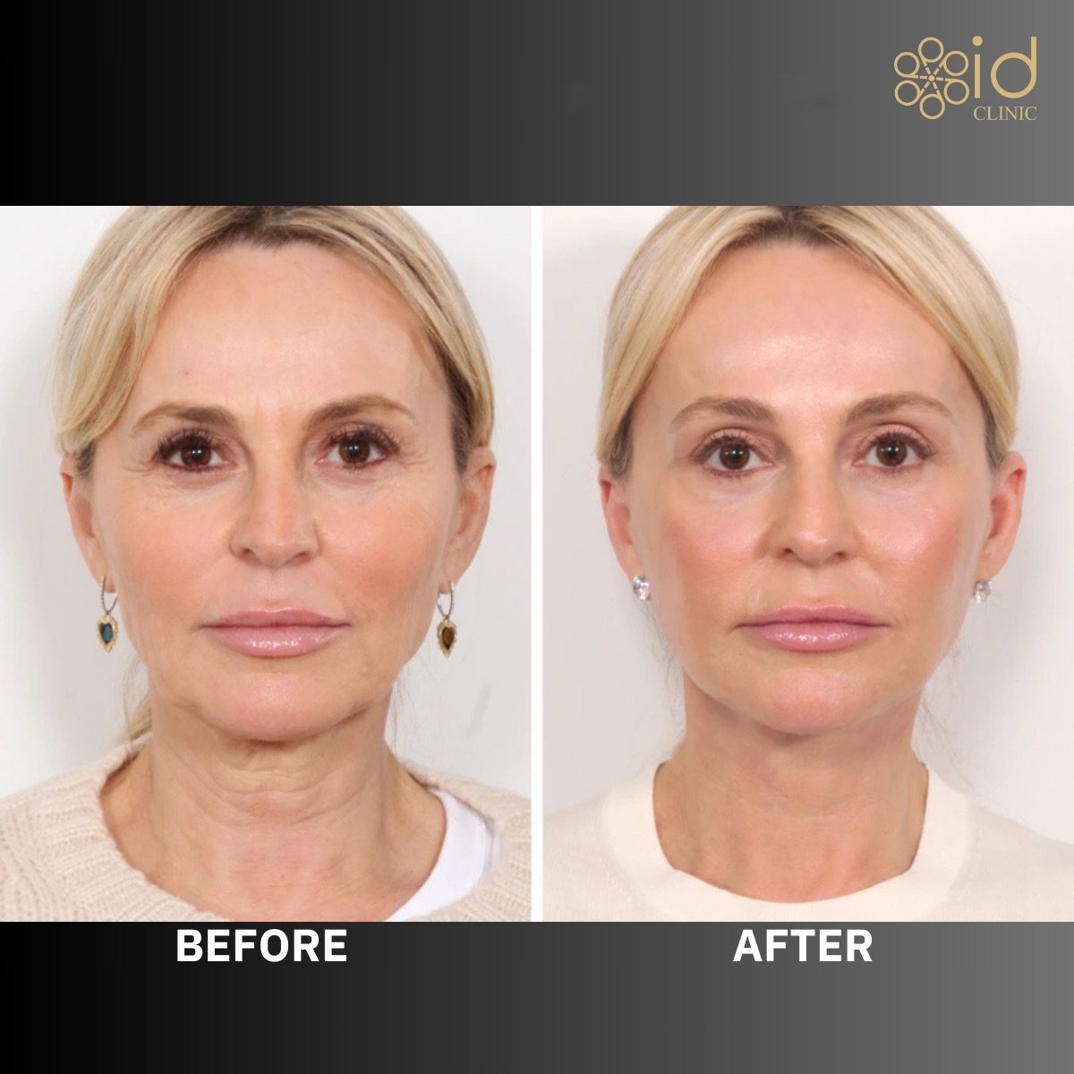 Lower eyelid blepharoplasty before and after results at ID Clinic Bangkok, rejuvenated eye area