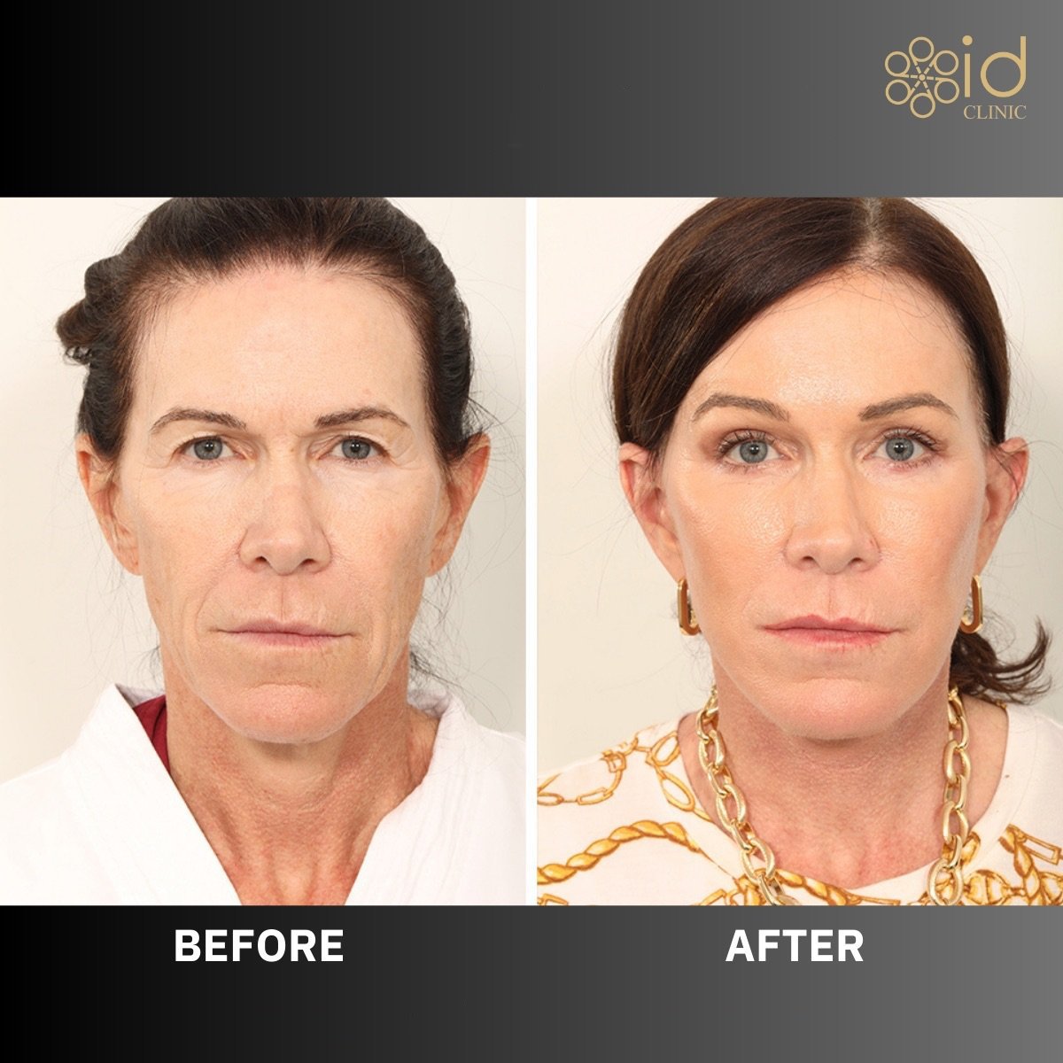 Before and after lower eyelid blepharoplasty results at ID Clinic Bangkok, rejuvenated eye area