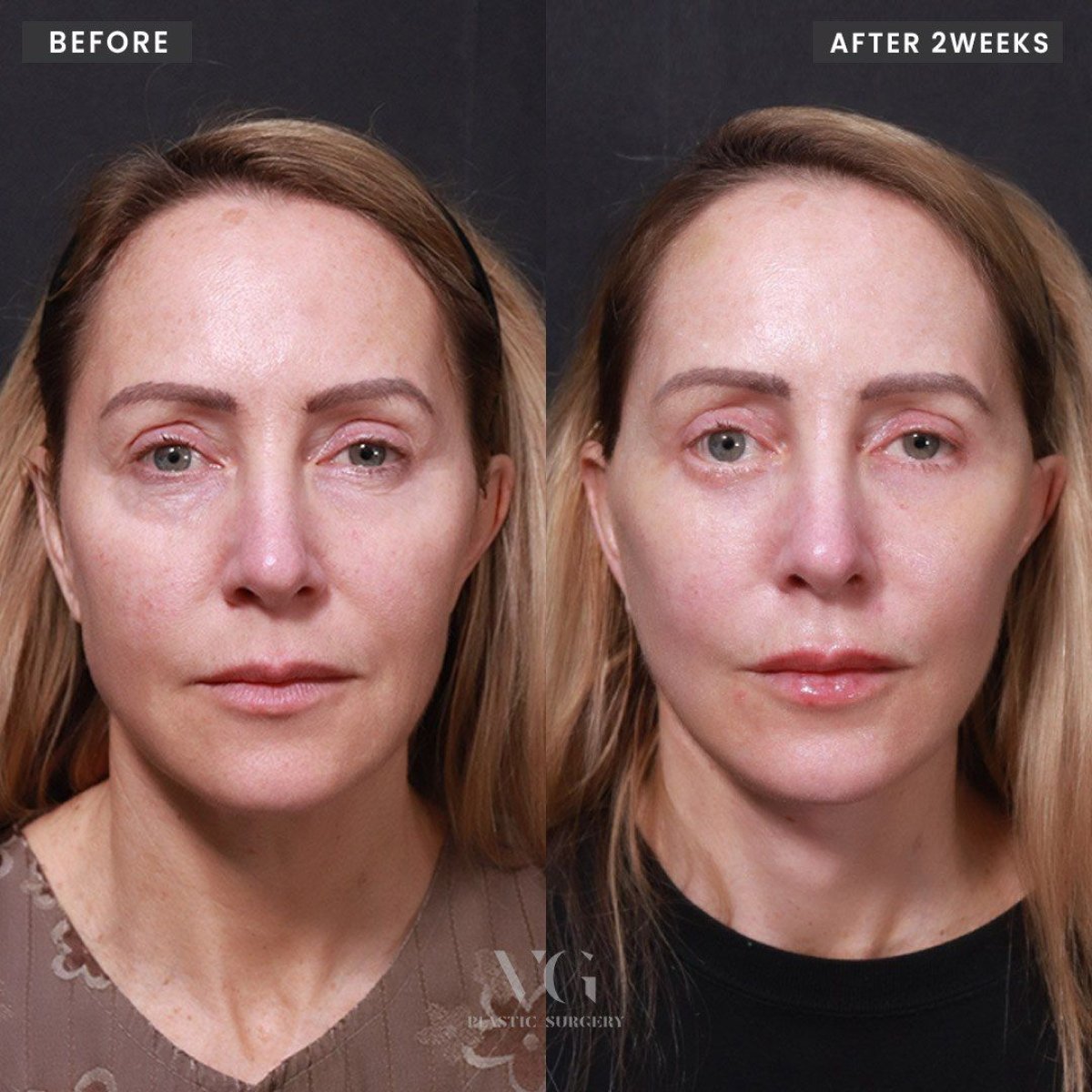 Vorher-nachher-Ergebnis Deep Plane Facelift bei VG Plastic Surgery, sichtbare Verjüngung